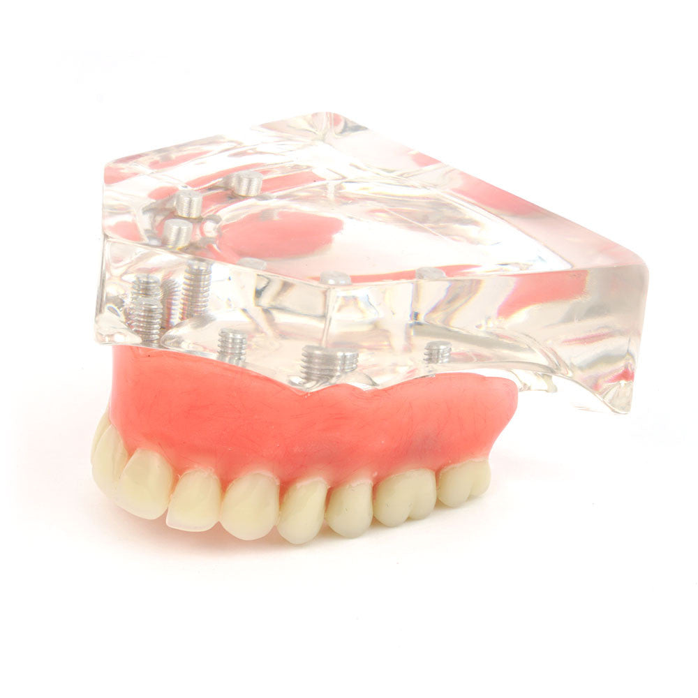 Overdenture model using 6 implant locators on an upper arch