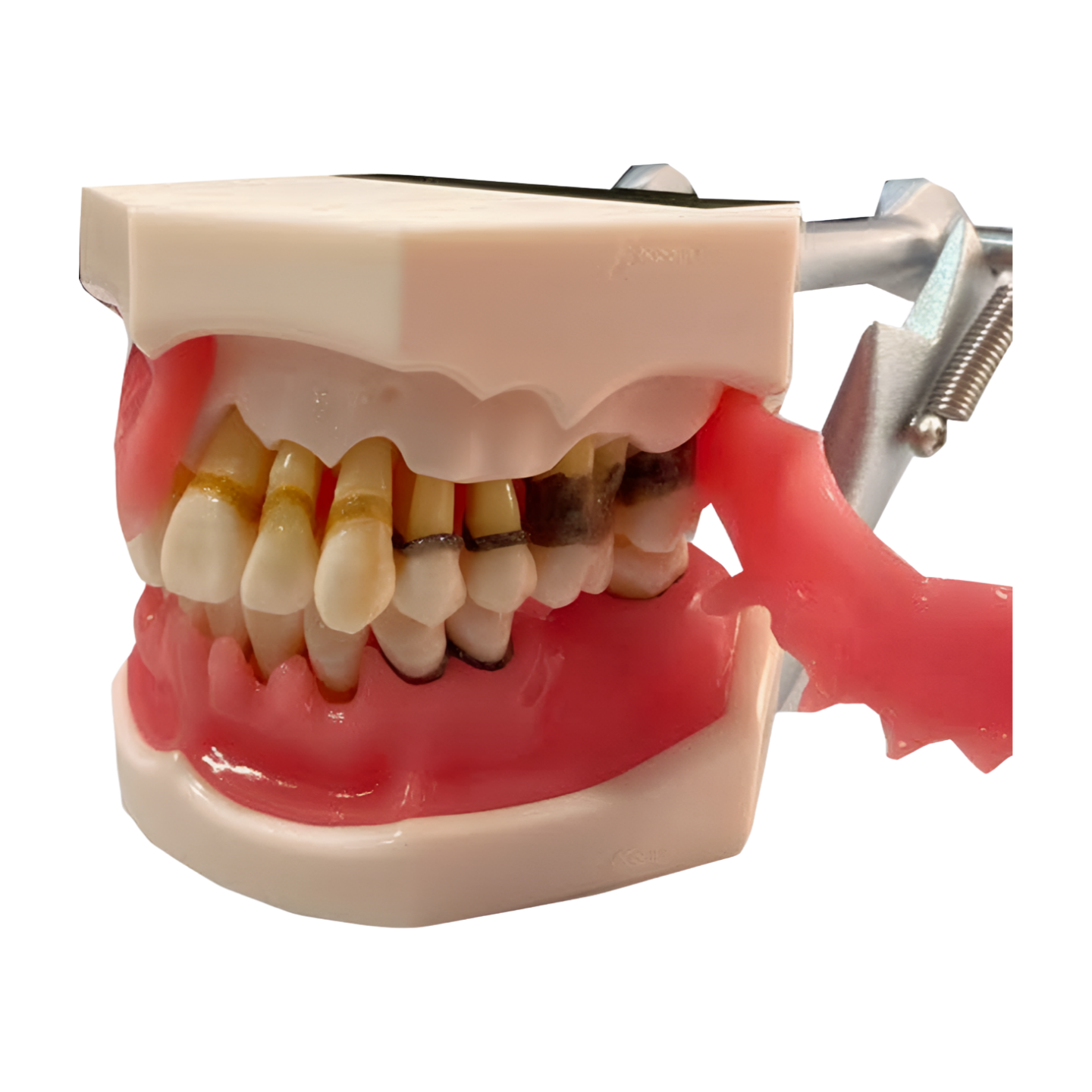 P15D-TRM.653 periodontal demonstration model, healthy vs affected quadrant, front view