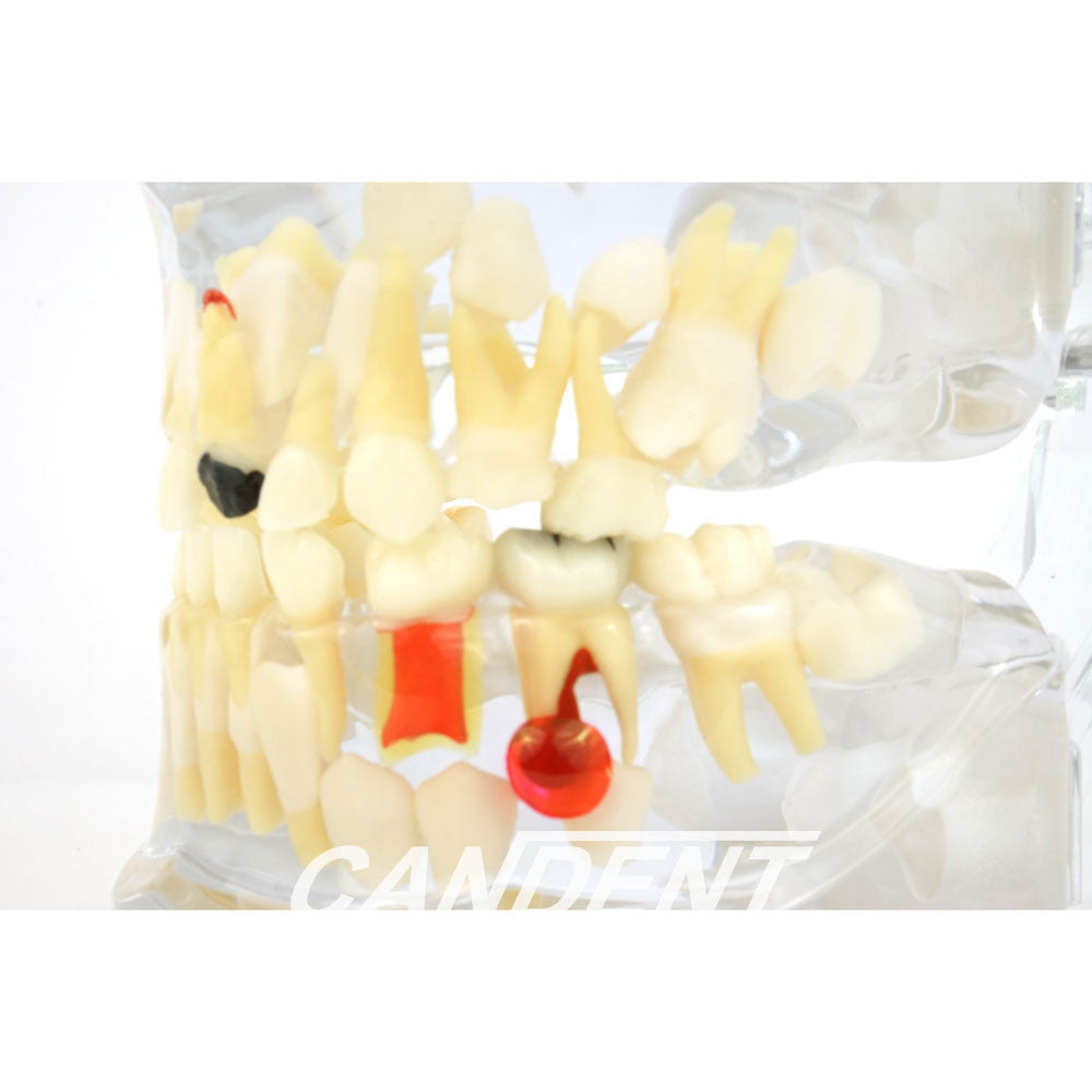 P12P-100R pathological pediatric model, ectopic eruption detail