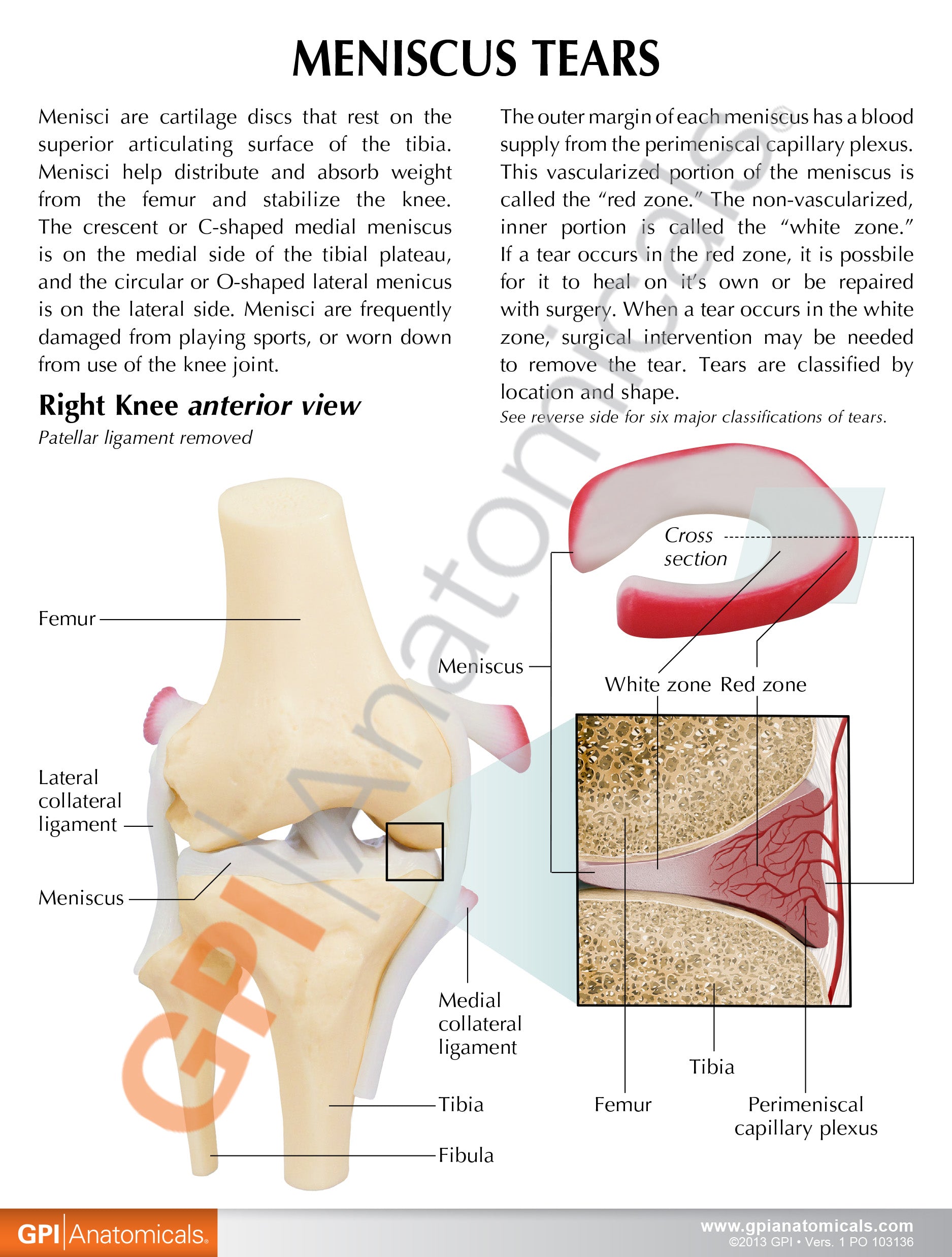 Meniscus Tears (6 Tears)