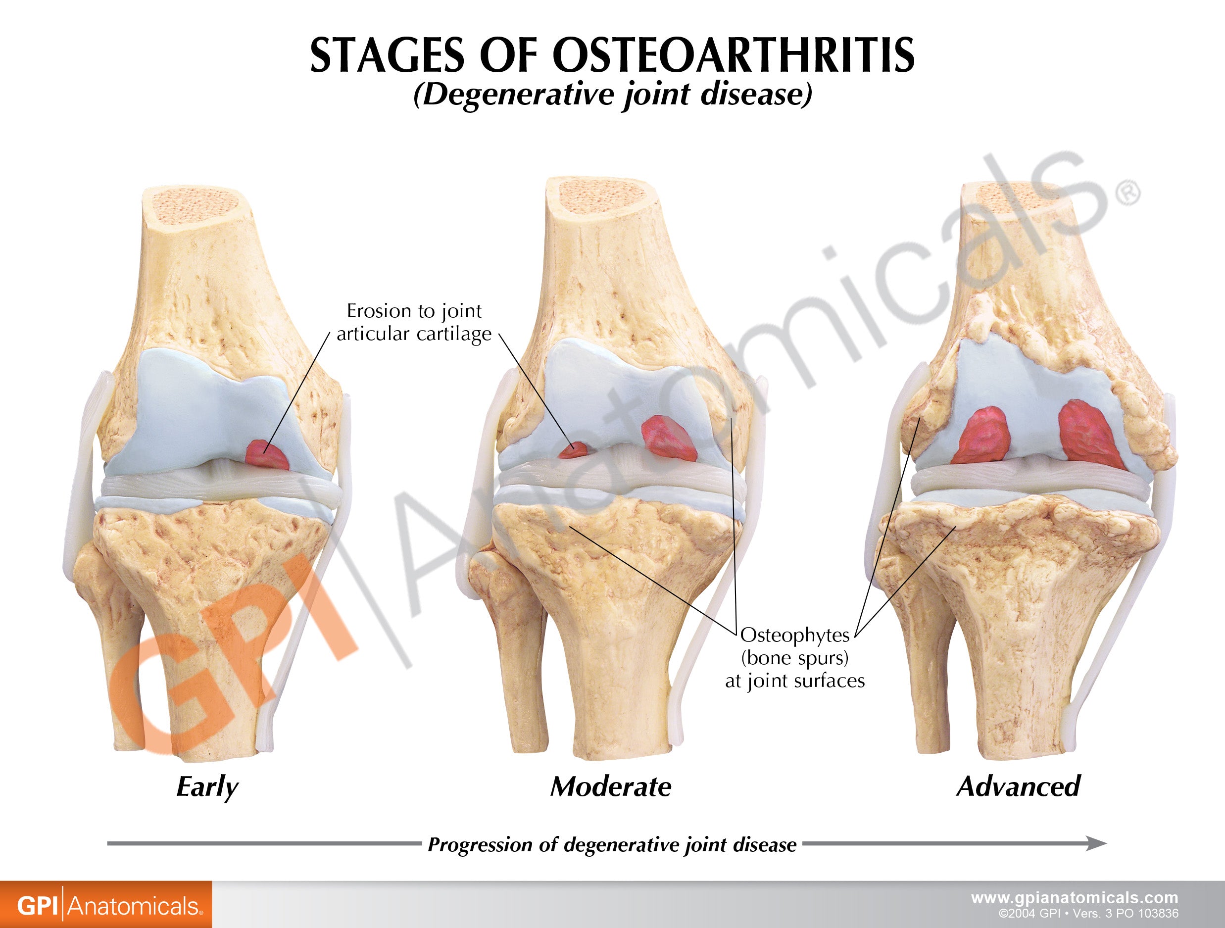 4-Stage Osteoarthritis Knee Set