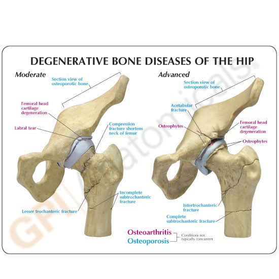 1320-degenerative-bone-diseases-of-the-hip-rear__19881.1589753011.1280.1280.jpg