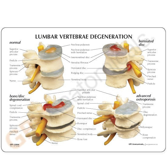 1760-lumbar-vertebrae-degeneration__65615.1589753113.1280.1280.jpg