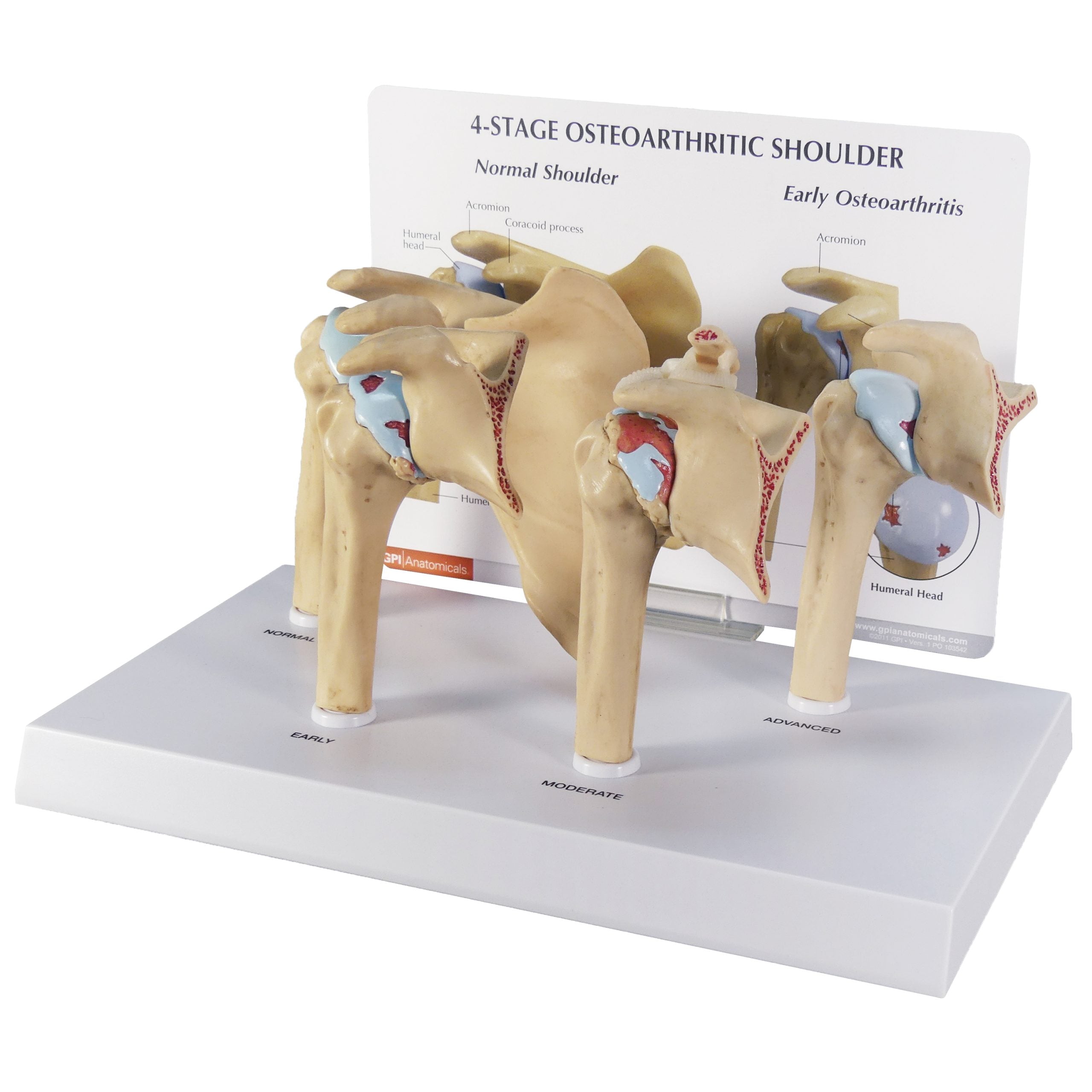 4-Stage Shoulder (Osteoarthritis)