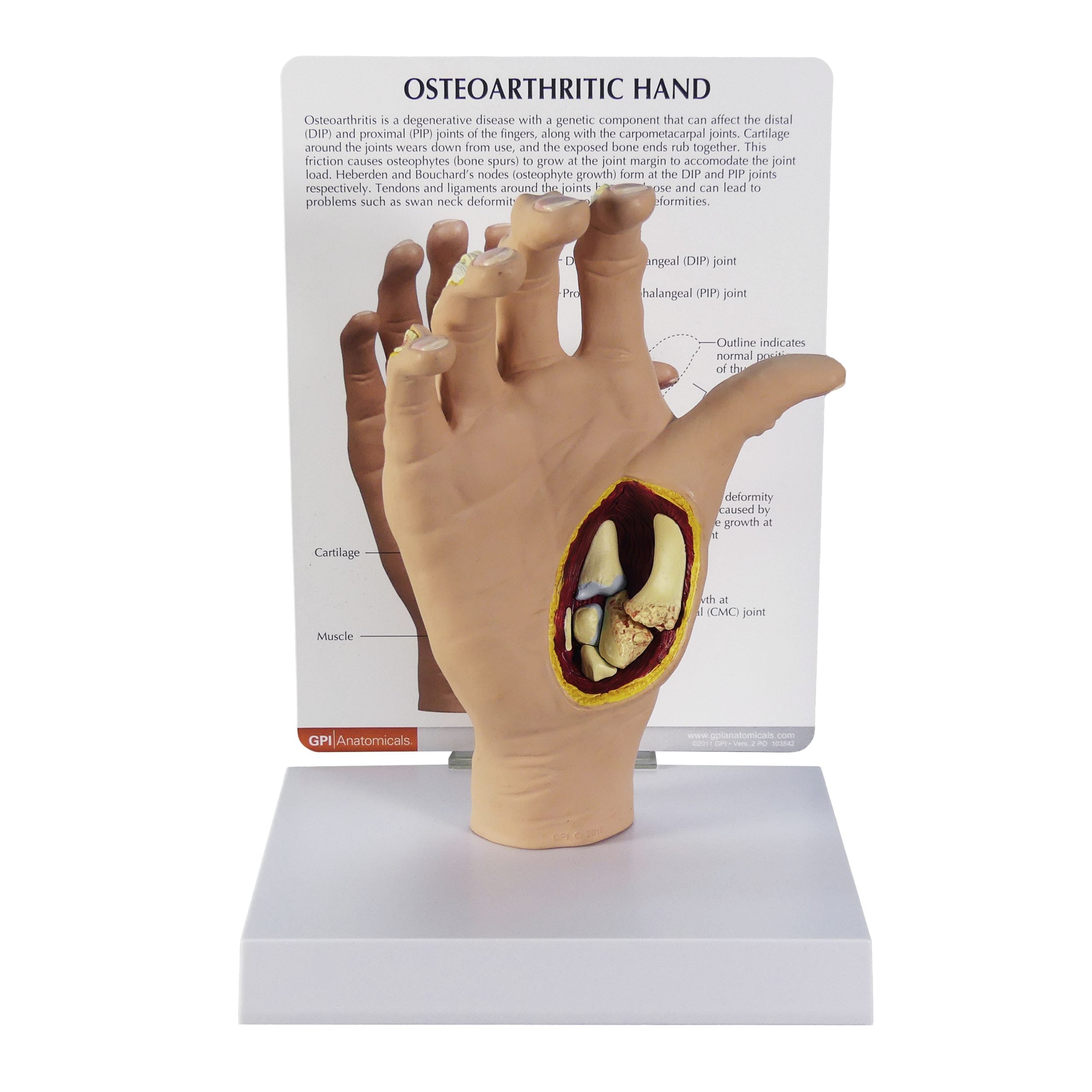Osteoarthritis (OA) Hand