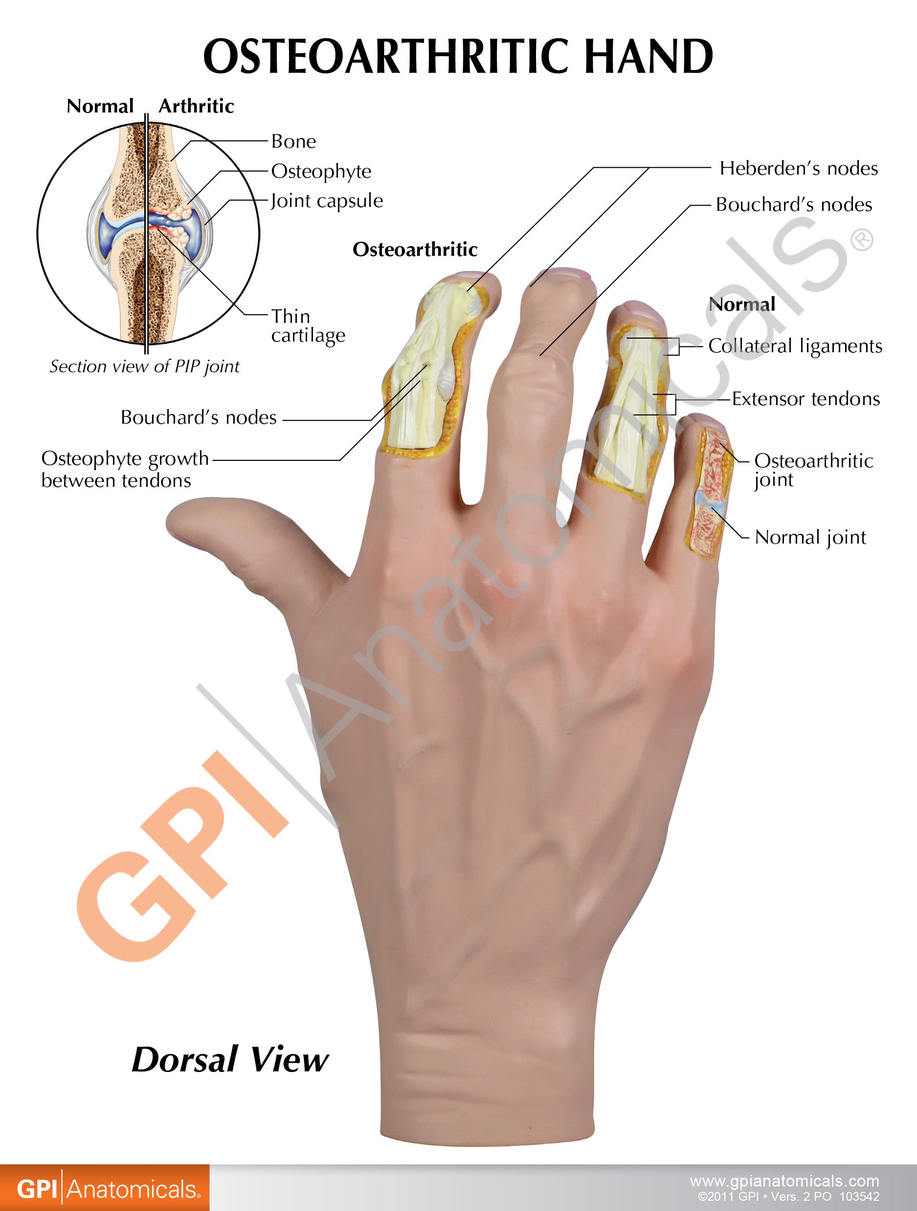 Osteoarthritis (OA) Hand