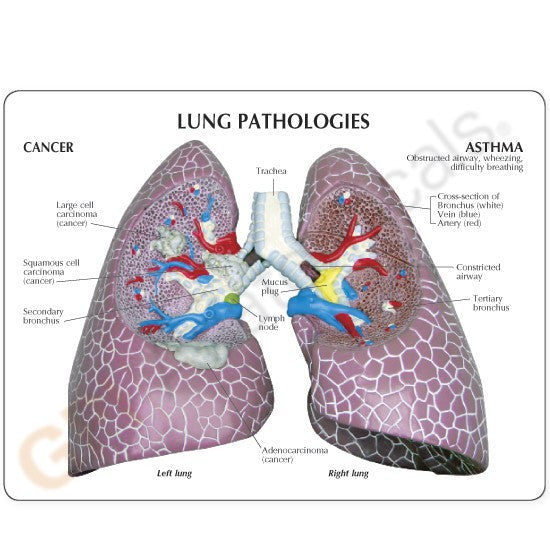 3110-lung-cancer-rear__39360.1589753072.1280.1280.jpg