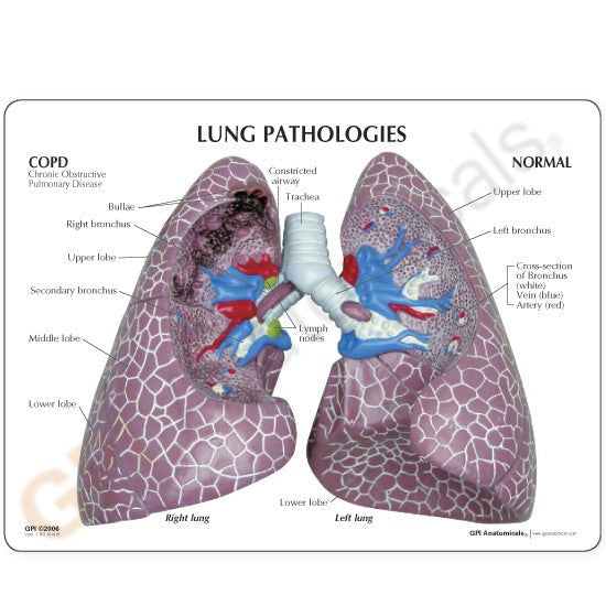 3110-lung-cancer__74319.1589753073.1280.1280.jpg