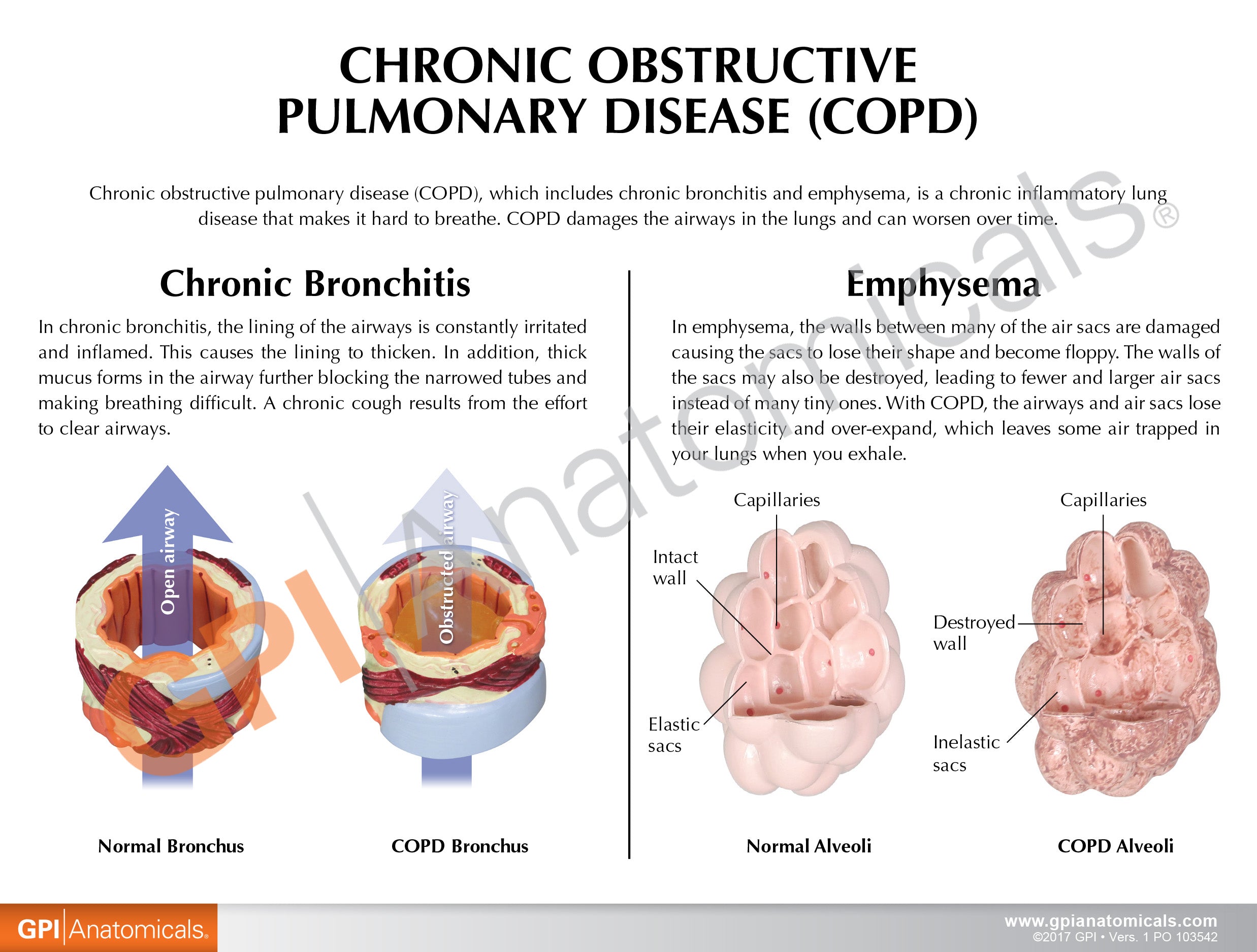 COPD (Bronchus/Aveoli)