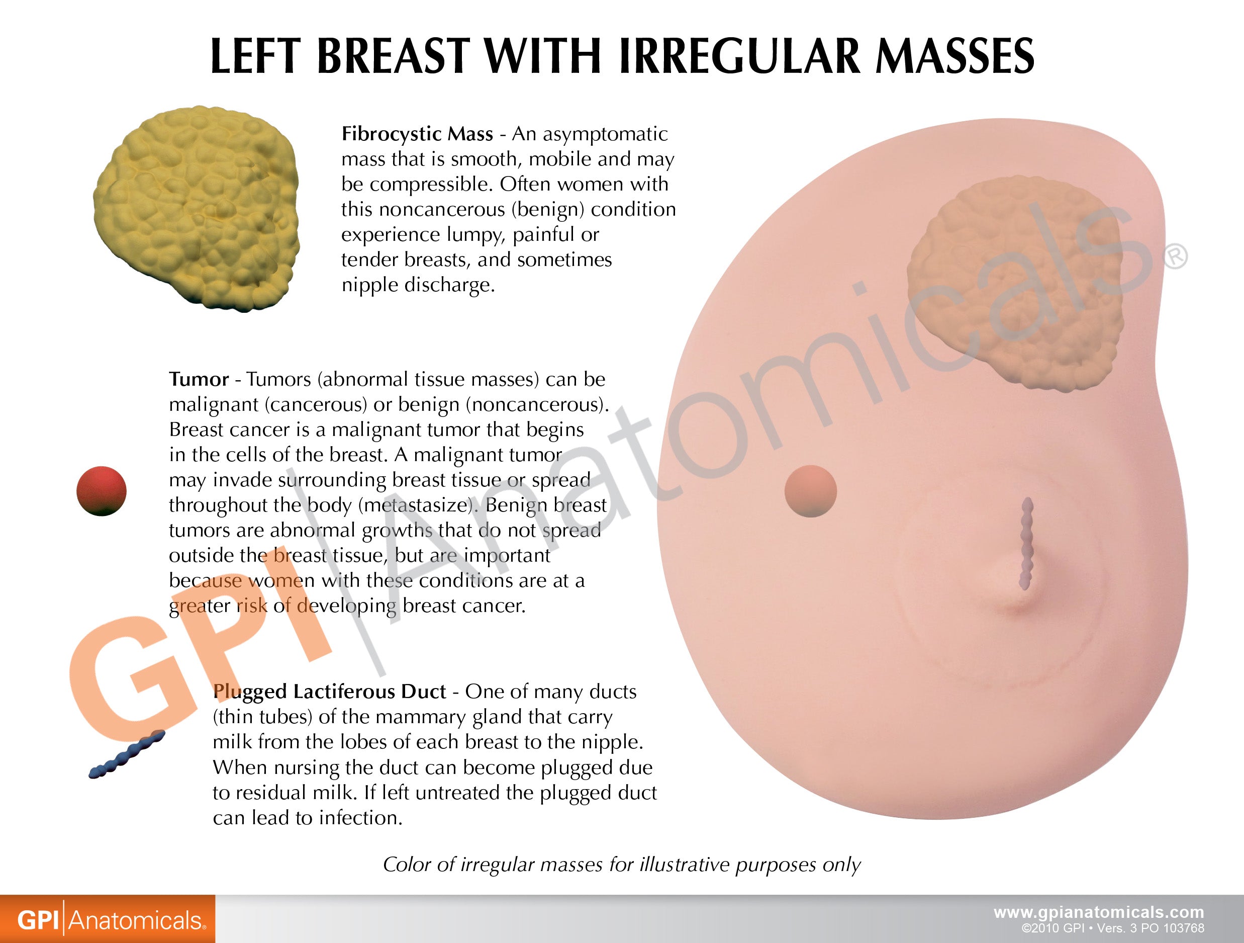 Left Breast (with Irregular Masses)
