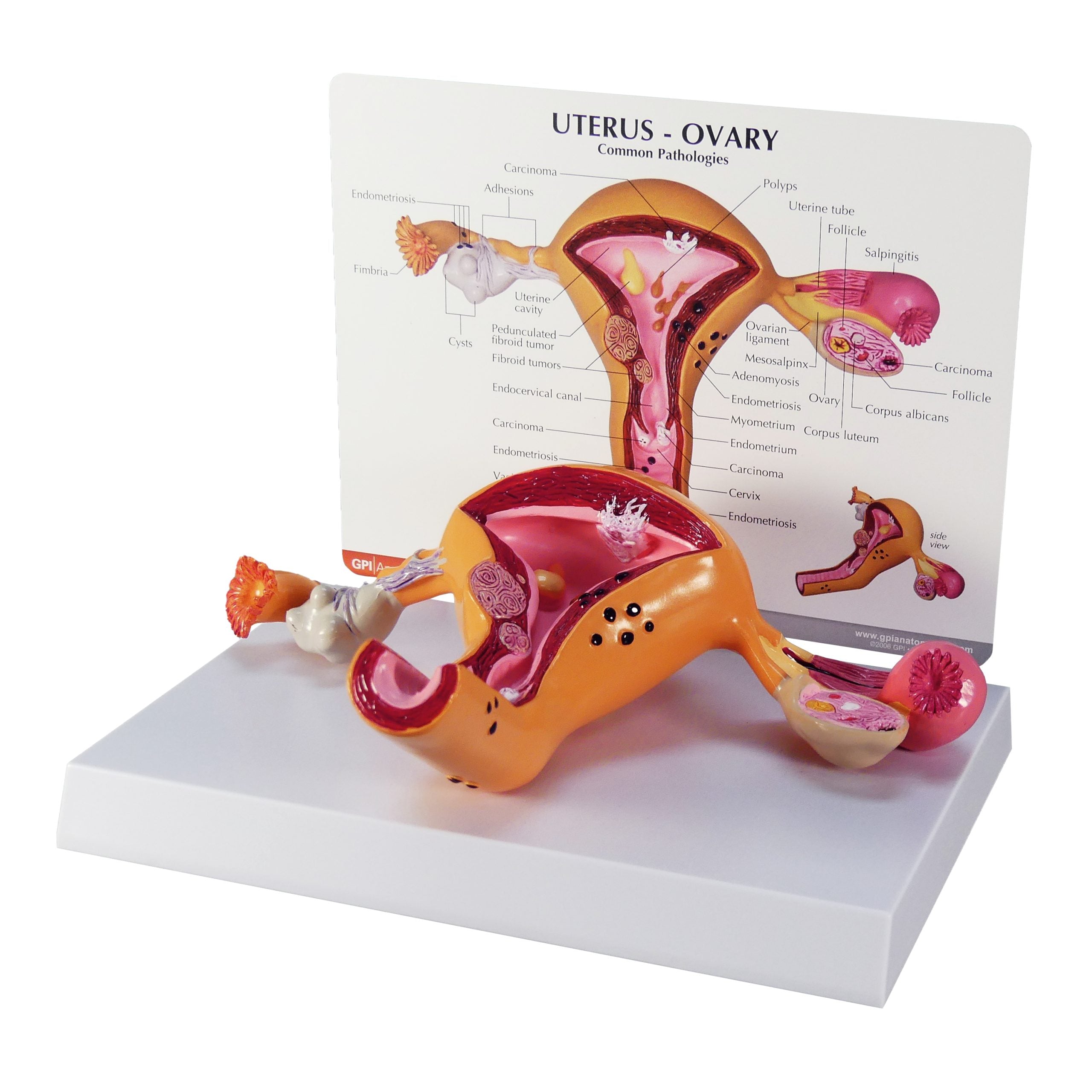 Uterus/Ovary