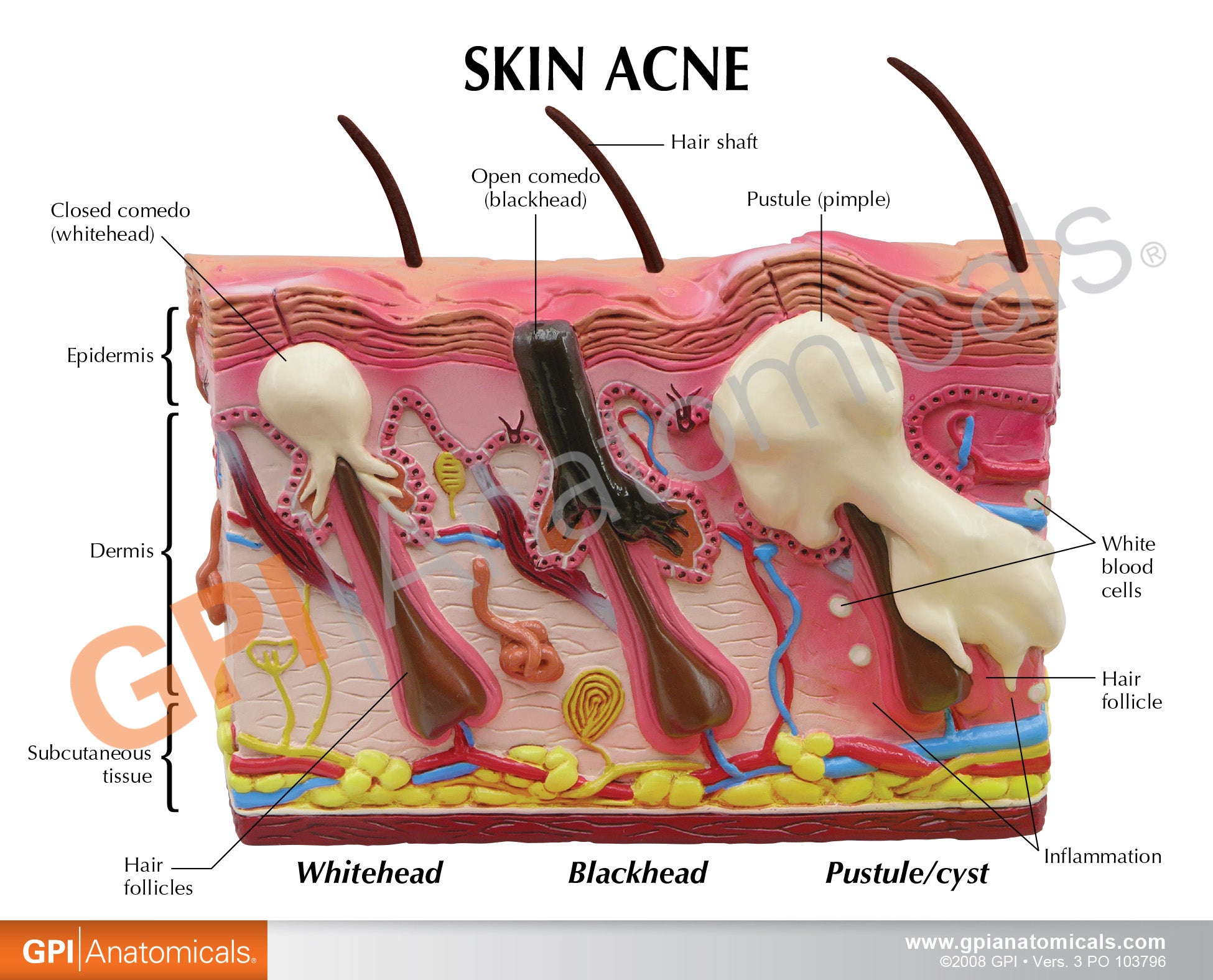 Skin Acne & Normal Skin (2-Sided)