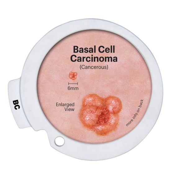 Precancerous & Cancerous Skin Lesions Hinged Disk Set