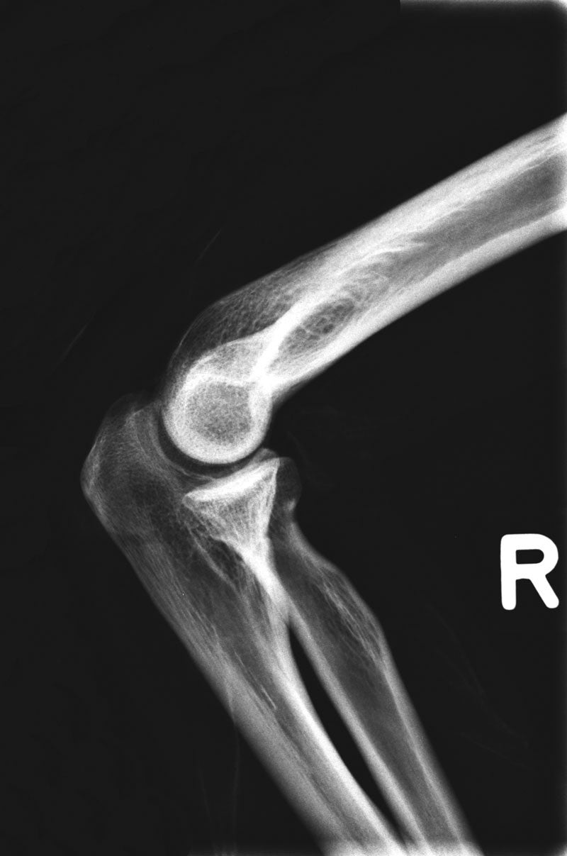Full Body X-Ray Phantom - Elbow
