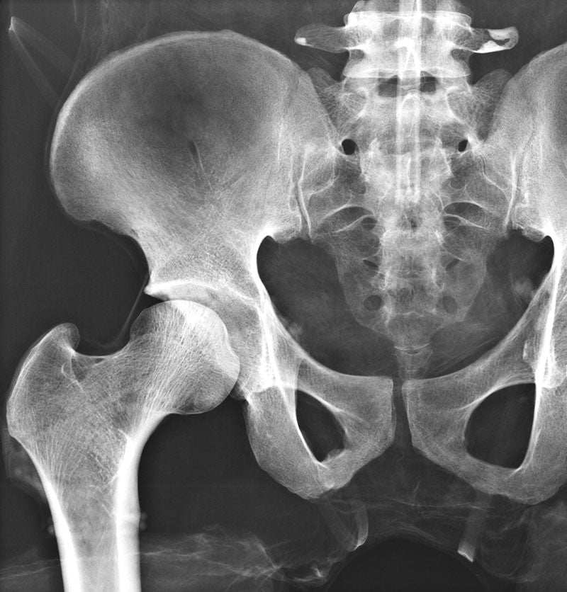 Full Body X-Ray Phantom - Hip