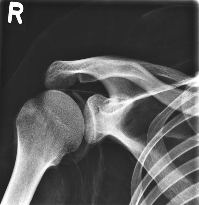 Full Body X-Ray Phantom - Shoulder