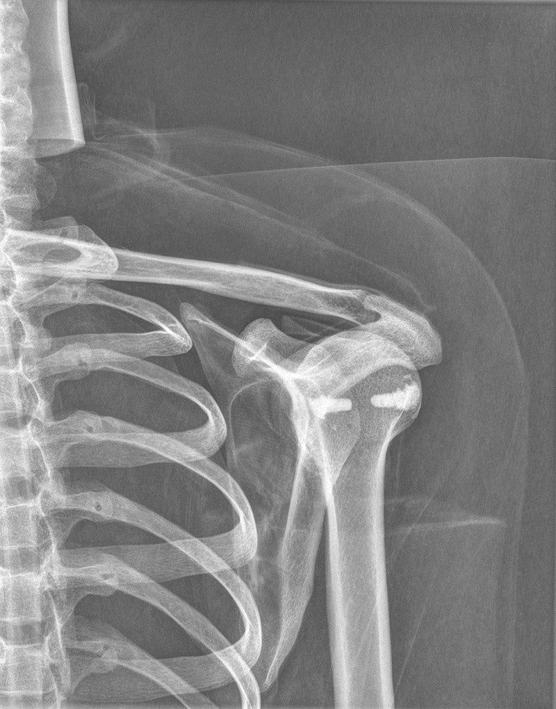 Full Body X-Ray Phantom - Shoulder Girdle