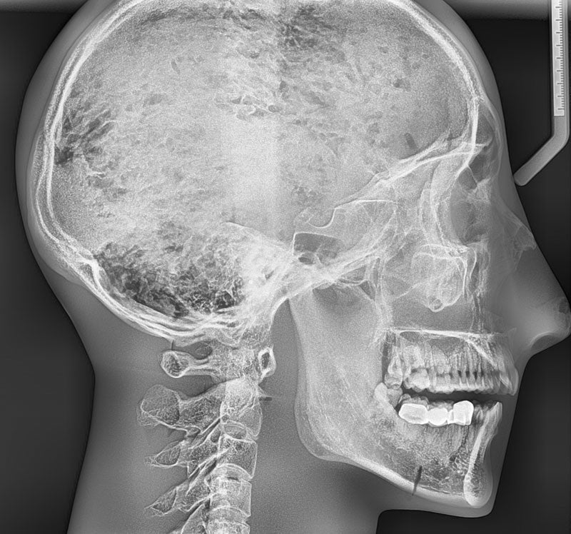X-ray phantom head with cervical vertebrae, opaque