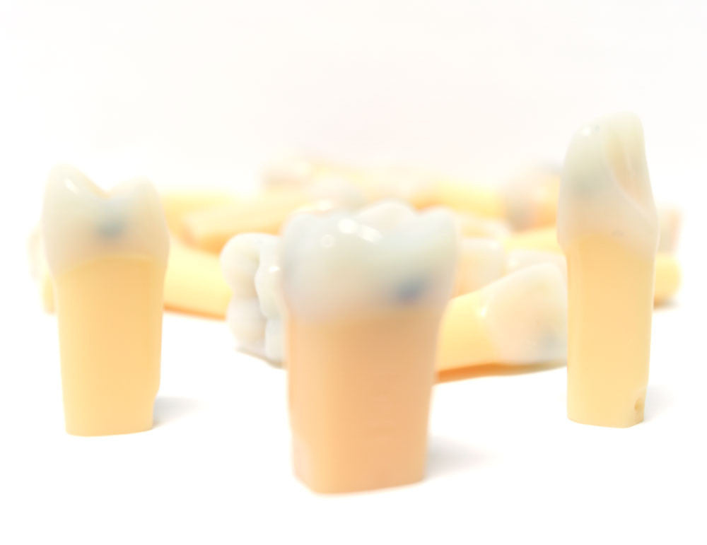 Composite Resin Teeth with Caries