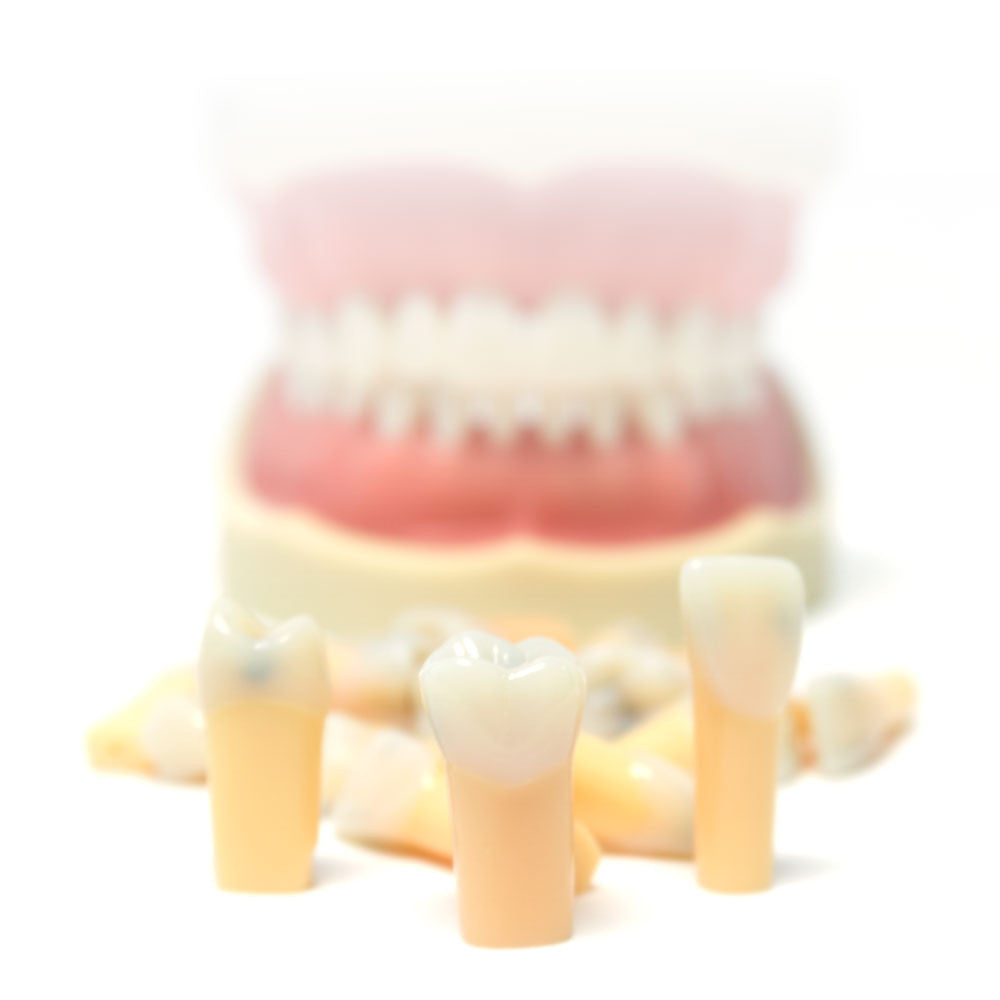 Composite Resin Teeth with Caries