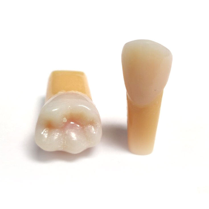 Composite Resin Tooth with Orange Caries - 36 and 13 for NDEB