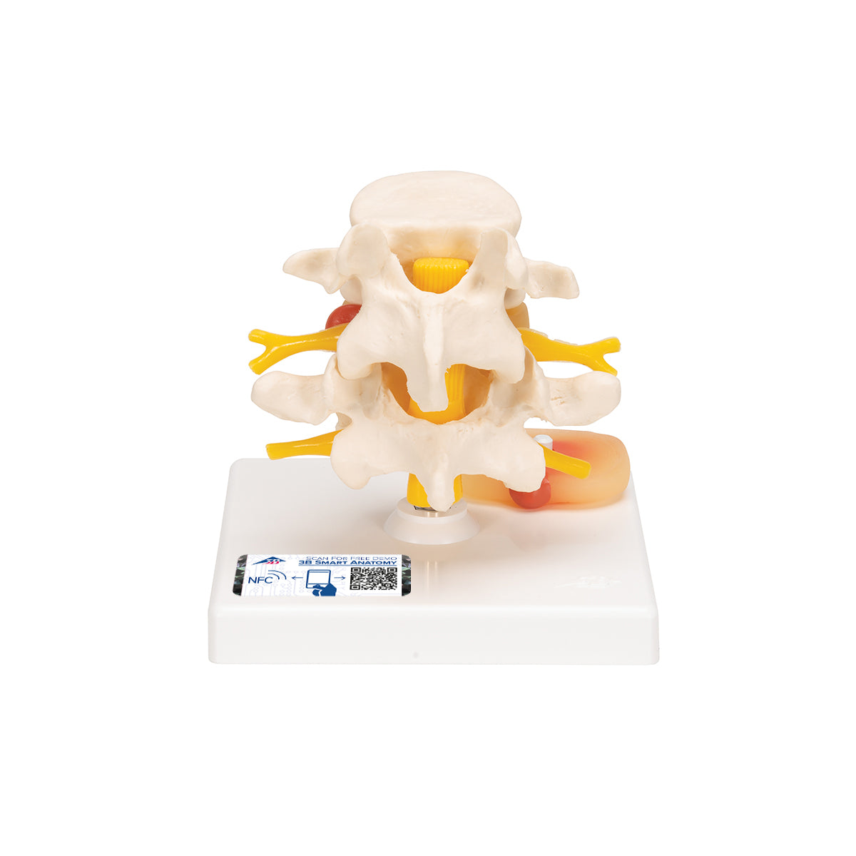 Human Lumbar Spinal Column with Prolapsed Intervertebral Disc - 3B Scientific A76, view 9