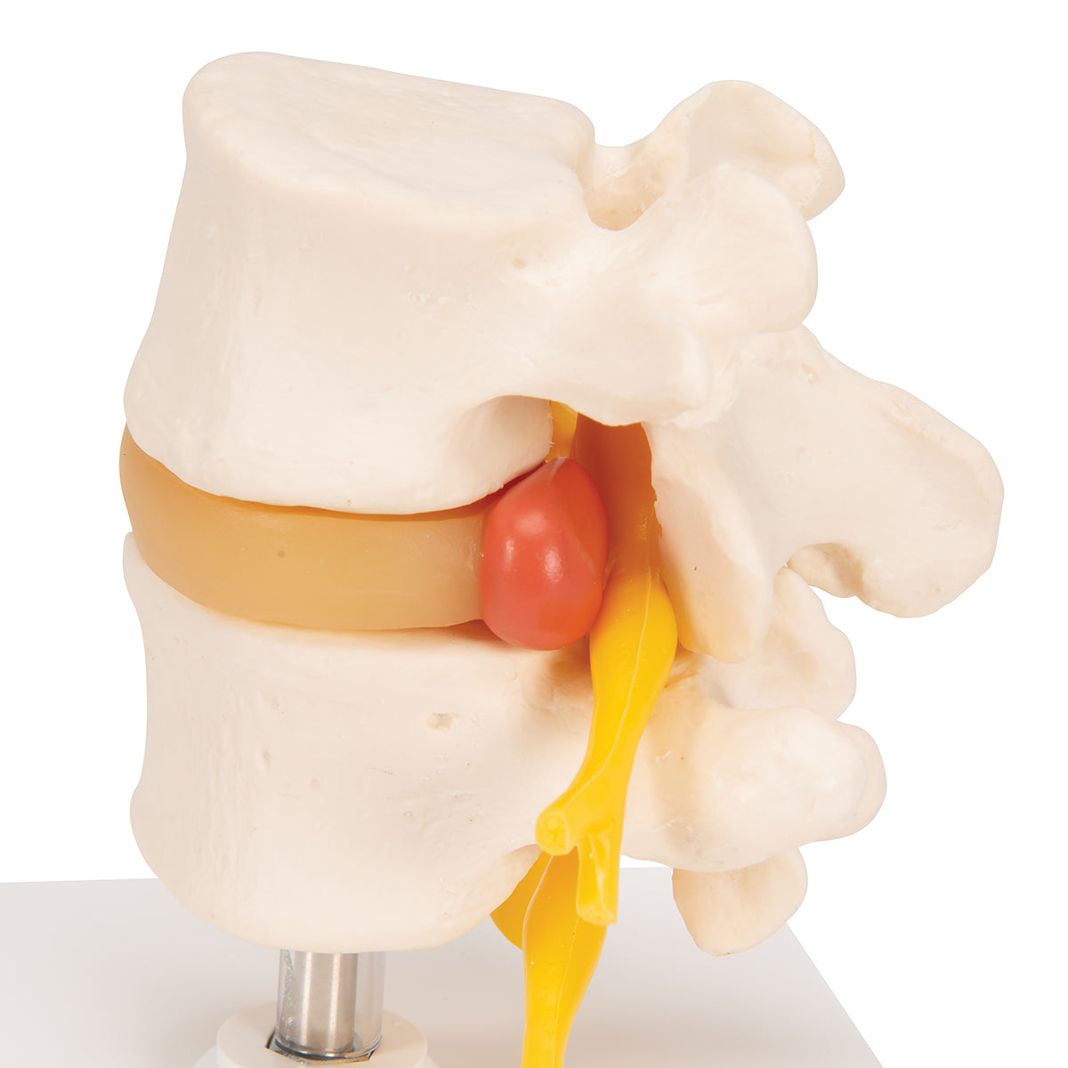 Human Lumbar Spinal Column with Prolapsed Intervertebral Disc - 3B Scientific A76, view 14
