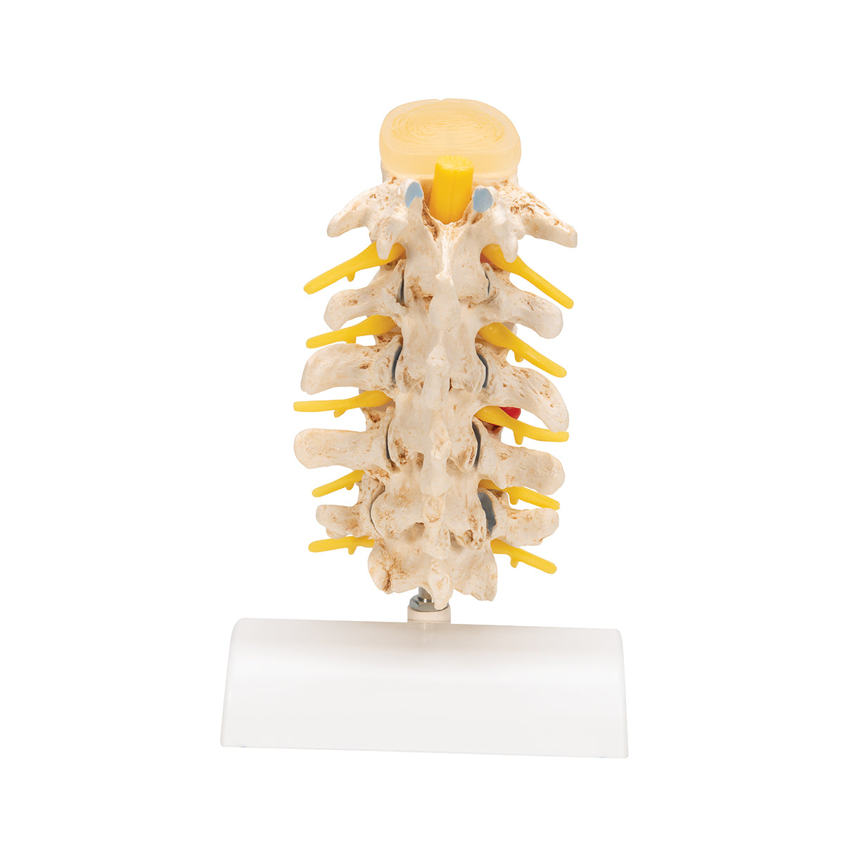 Stages of disc prolapse and vertebral degeneration - 3B Scientific A795, view 4