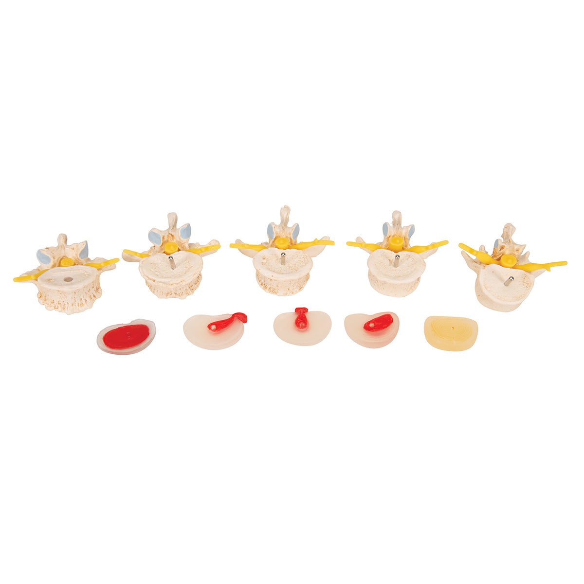 Stages of disc prolapse and vertebral degeneration - 3B Scientific A795, view 6