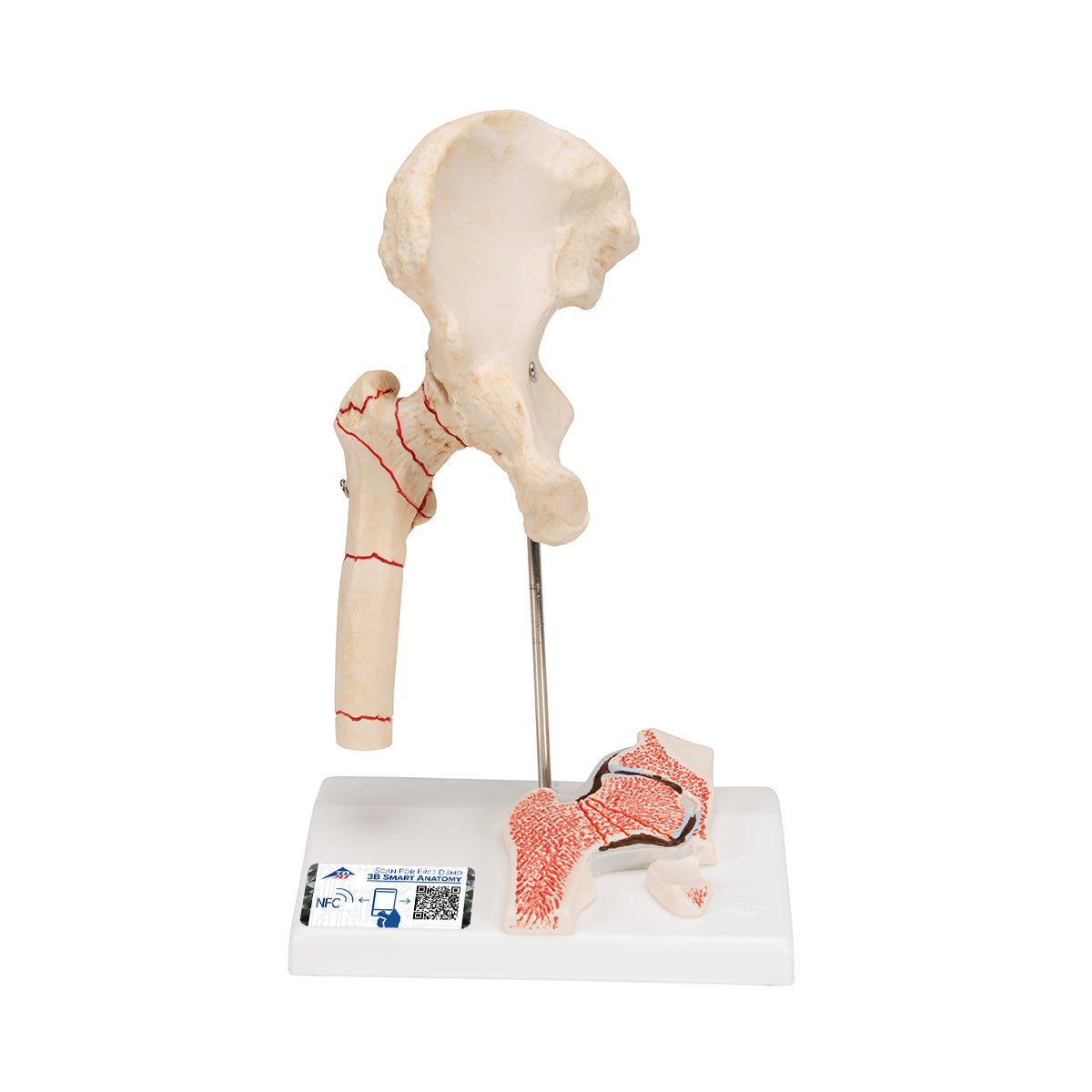 Human Femoral Fracture & Hip Osteoarthritis Model - 3B Scientific A88, view 8