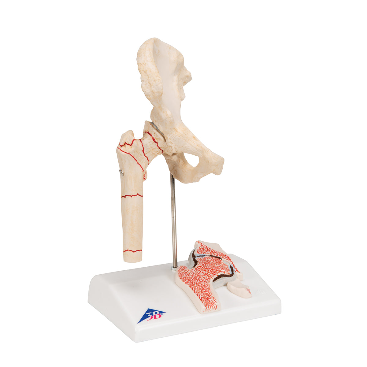 Human Femoral Fracture & Hip Osteoarthritis Model - 3B Scientific A88, view 2