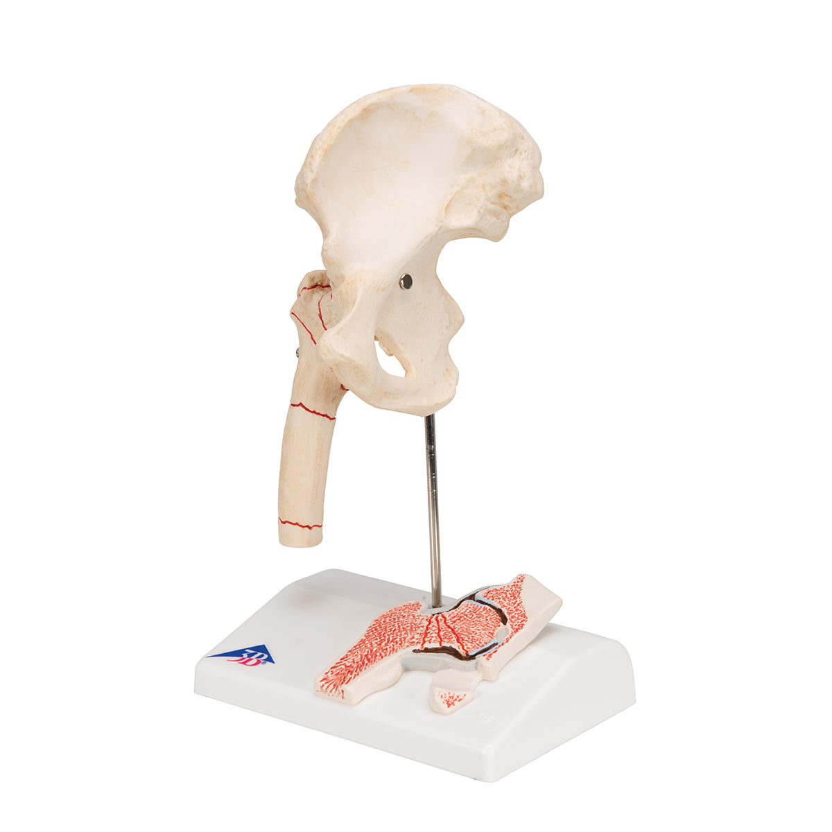 Human Femoral Fracture & Hip Osteoarthritis Model - 3B Scientific A88, view 4