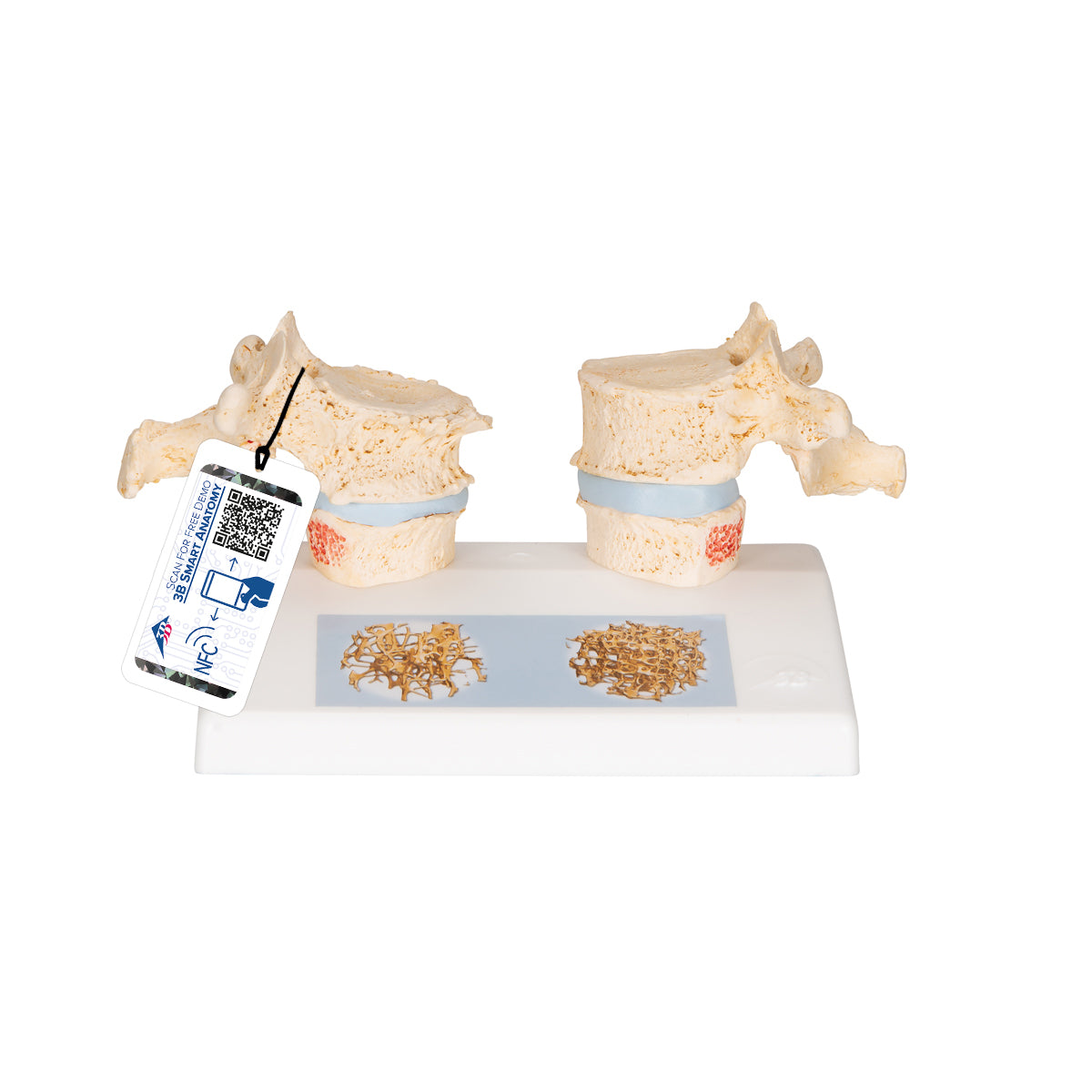 Osteoporosis Didactic Model A95 — 3B Scientific