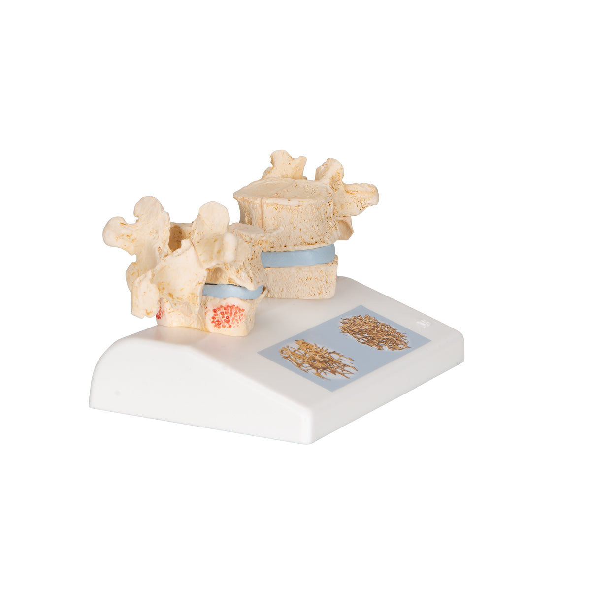 Osteoporosis Didactic Model