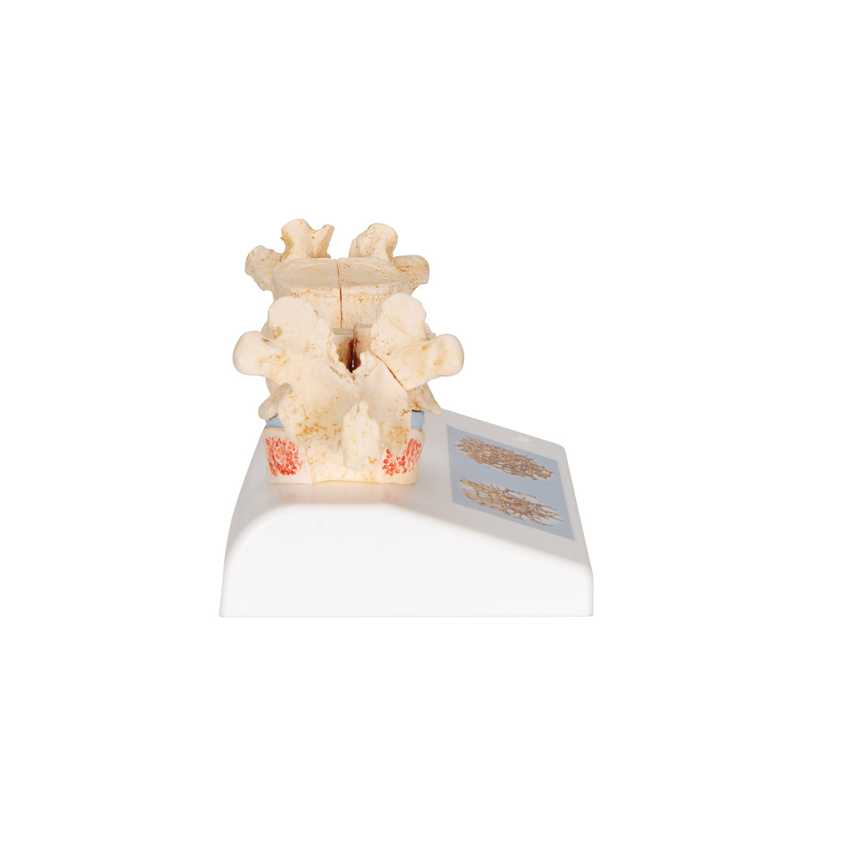 Osteoporosis Didactic Model