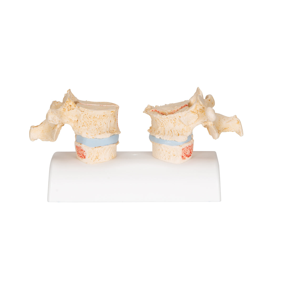 Osteoporosis Didactic Model