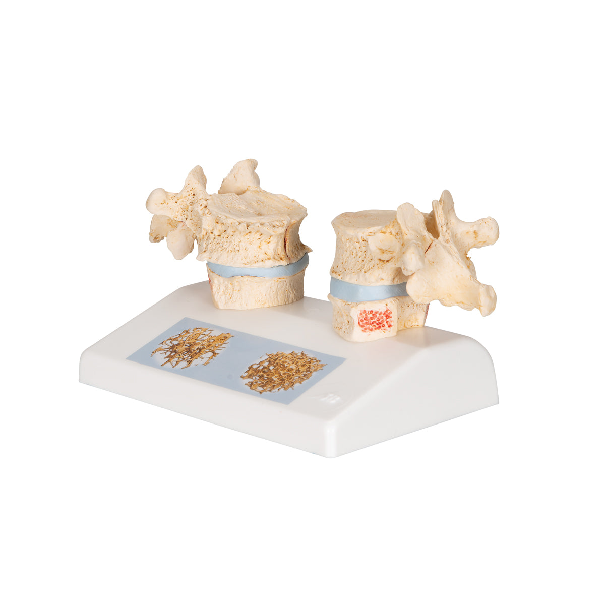 Osteoporosis Didactic Model