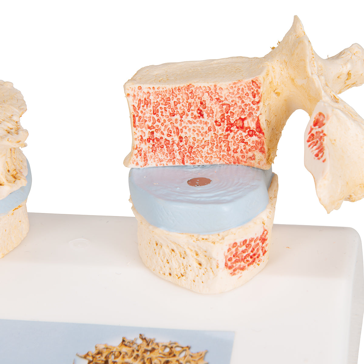 Osteoporosis Didactic Model