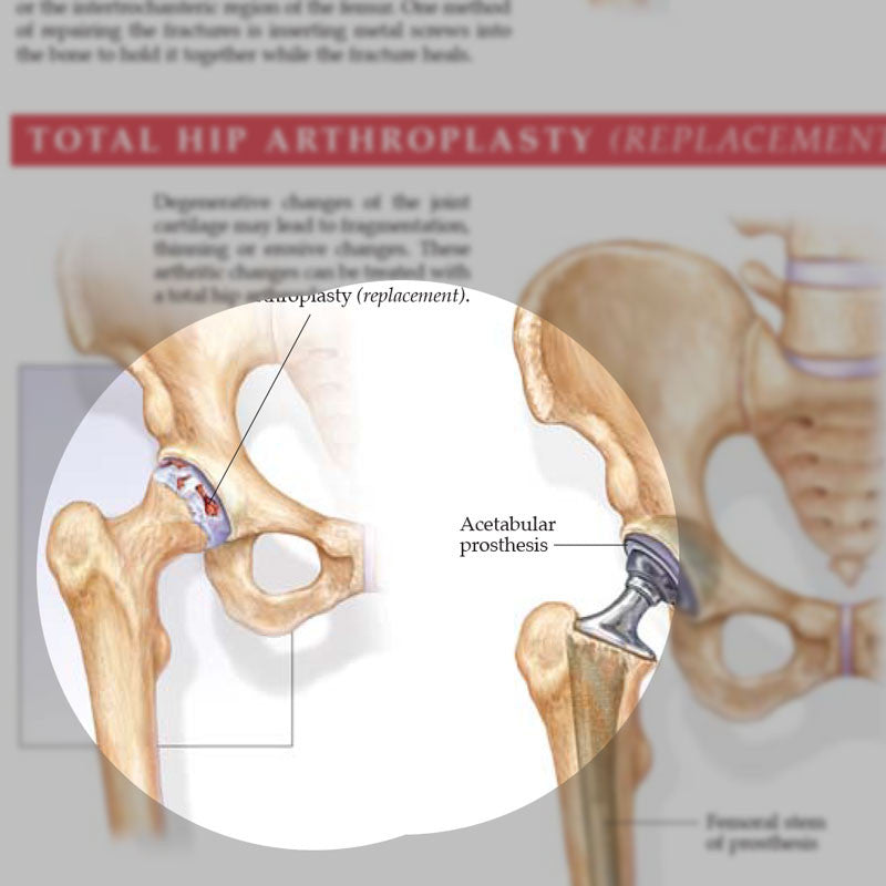 Anatomy and Injuries of the Hip - detail