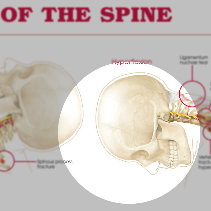 Anatomy and Injuries of the Spine Chart - detail