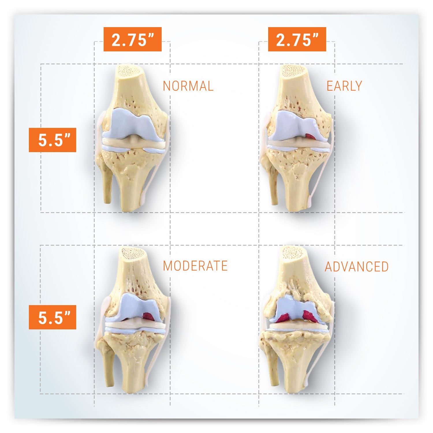4-Stage Osteoarthritis Knee Set