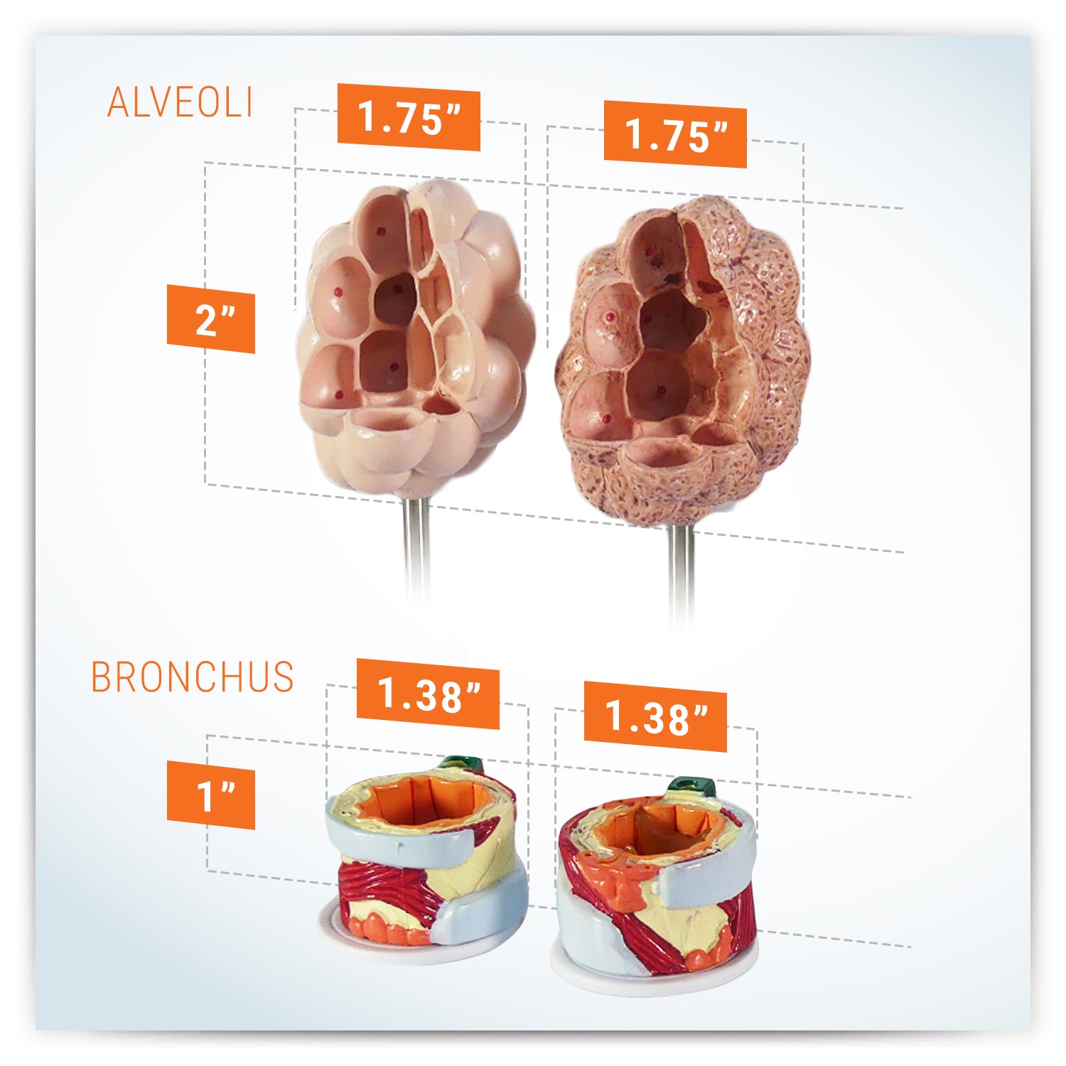 COPD (Bronchus/Aveoli)