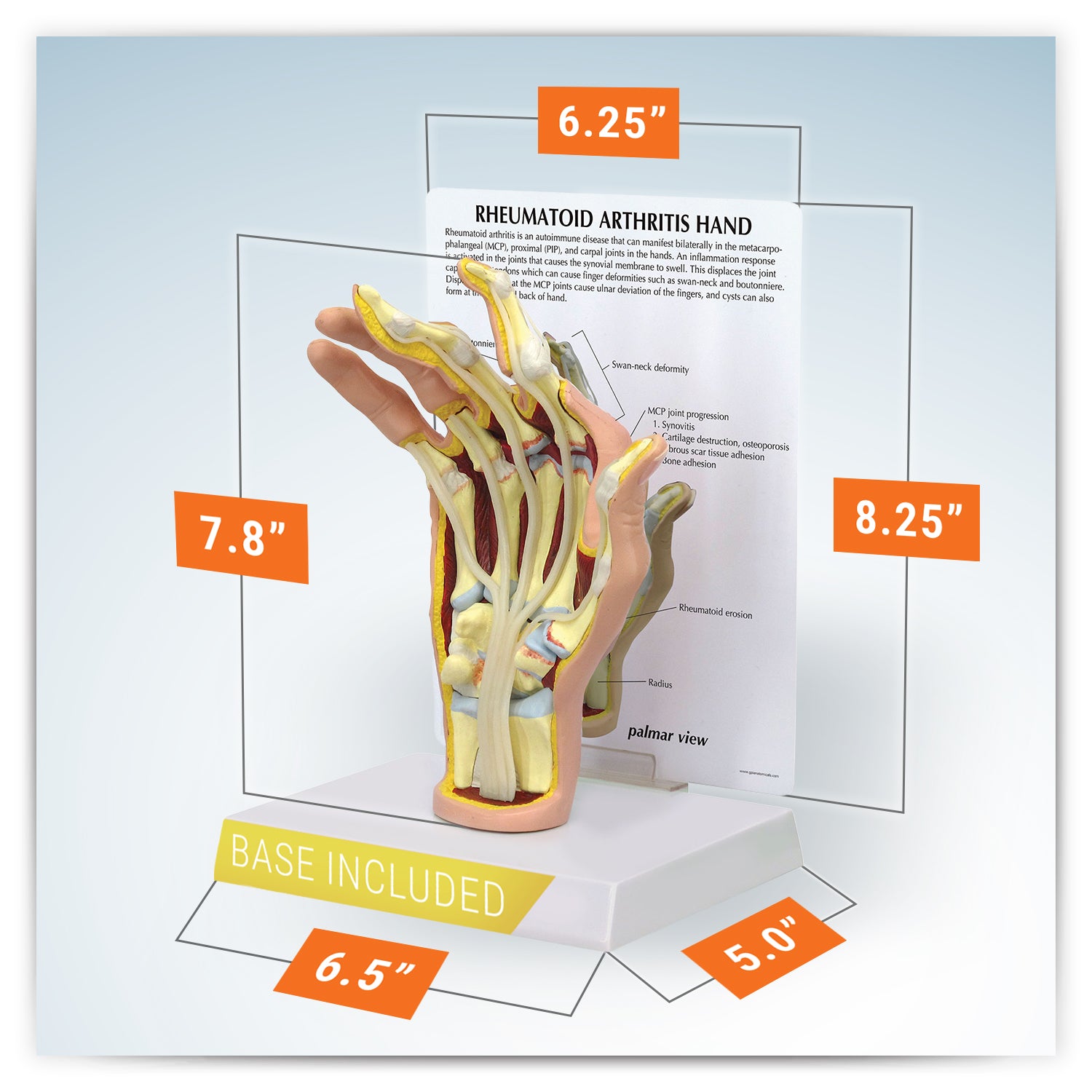 Rheumatoidarthritis (RA) Hand