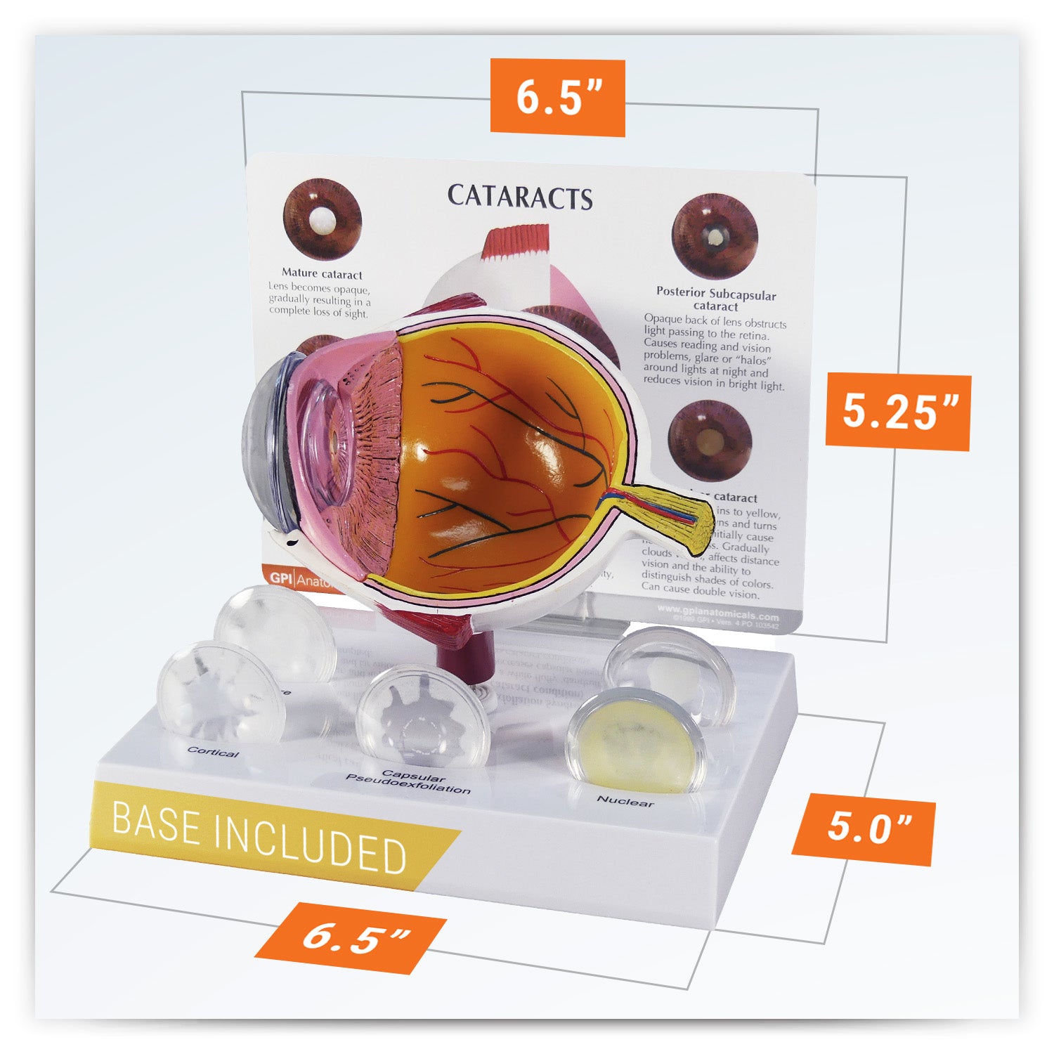 Cataract Eye (cut-away)
