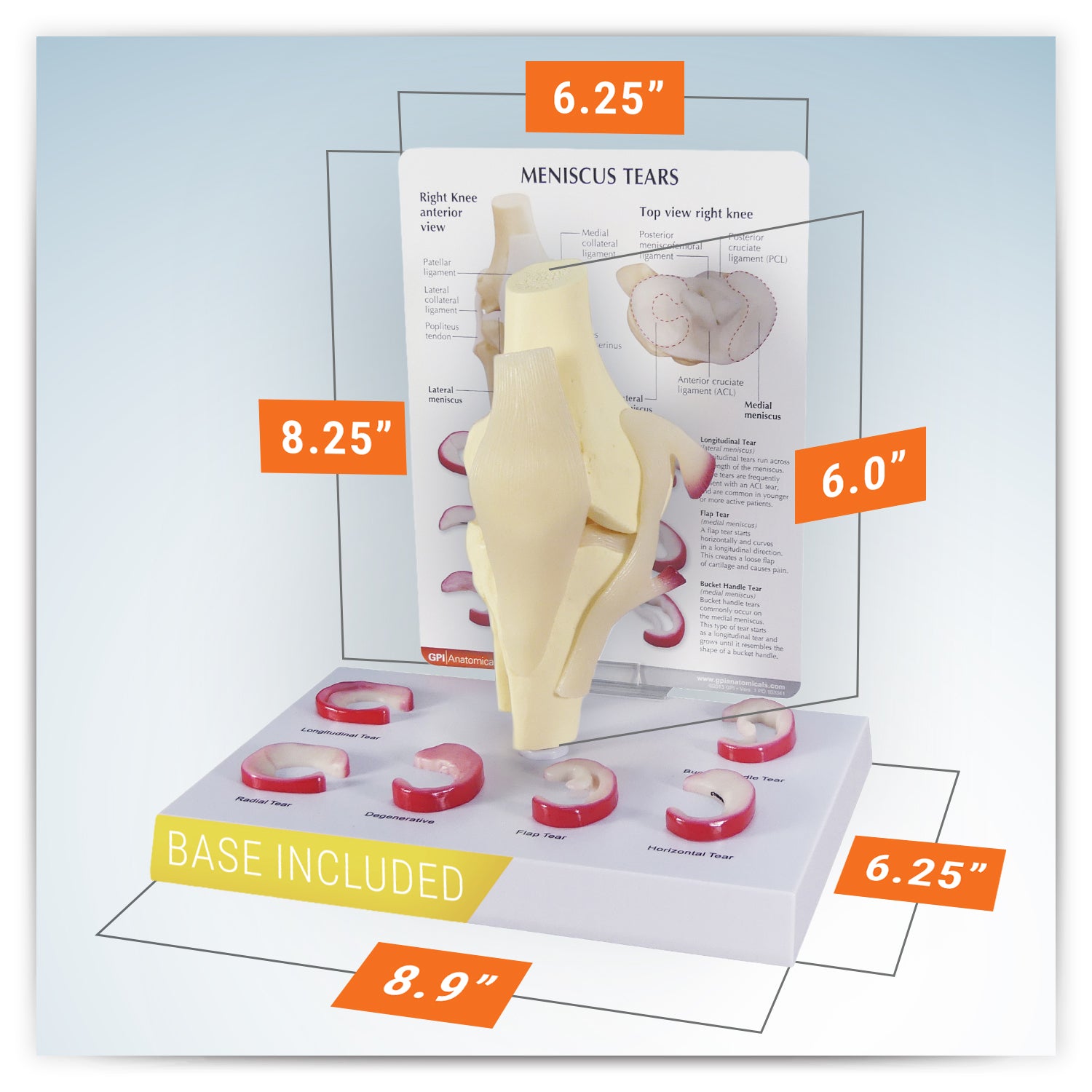 Meniscus Tears (6 Tears)