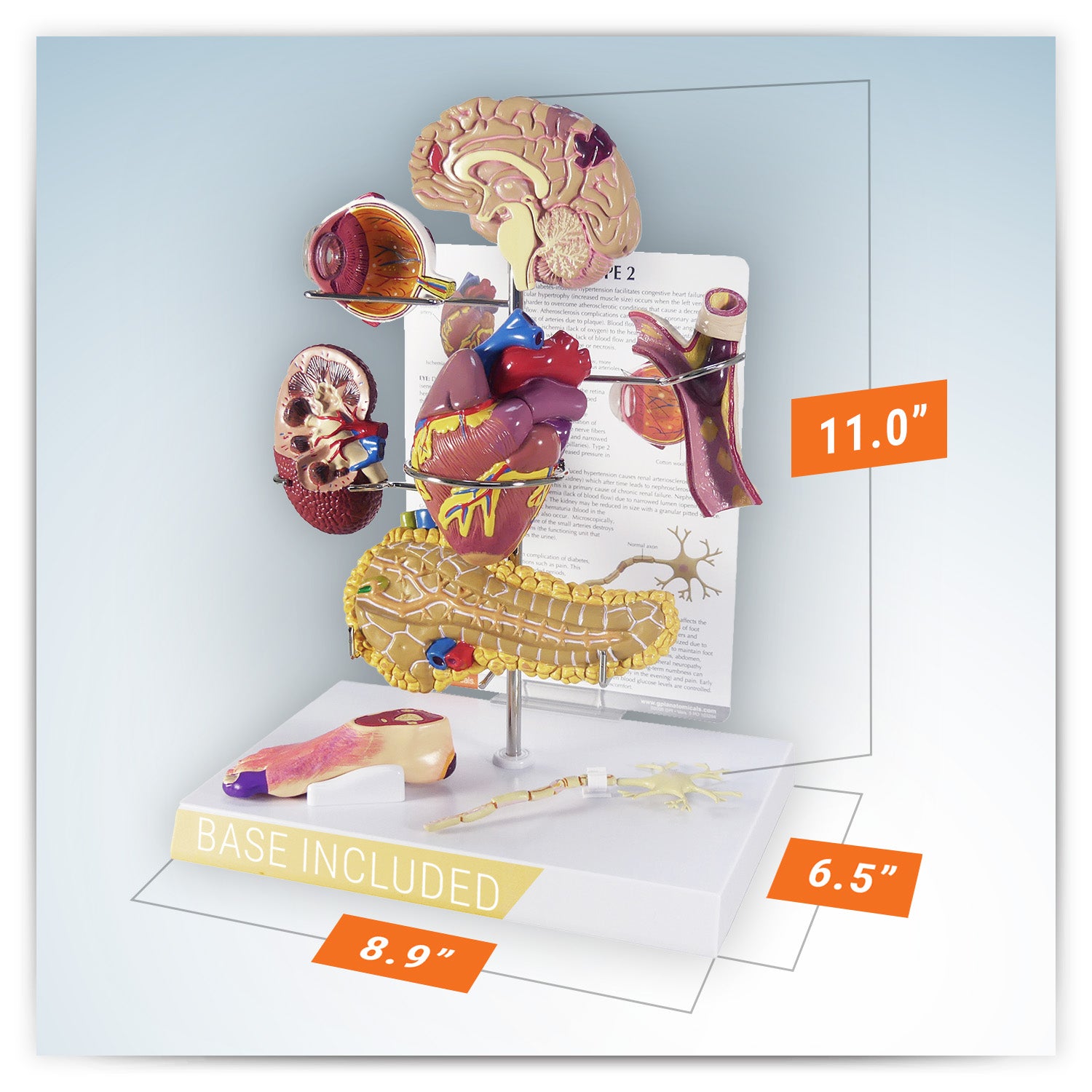 Type II Diabetes Set Model