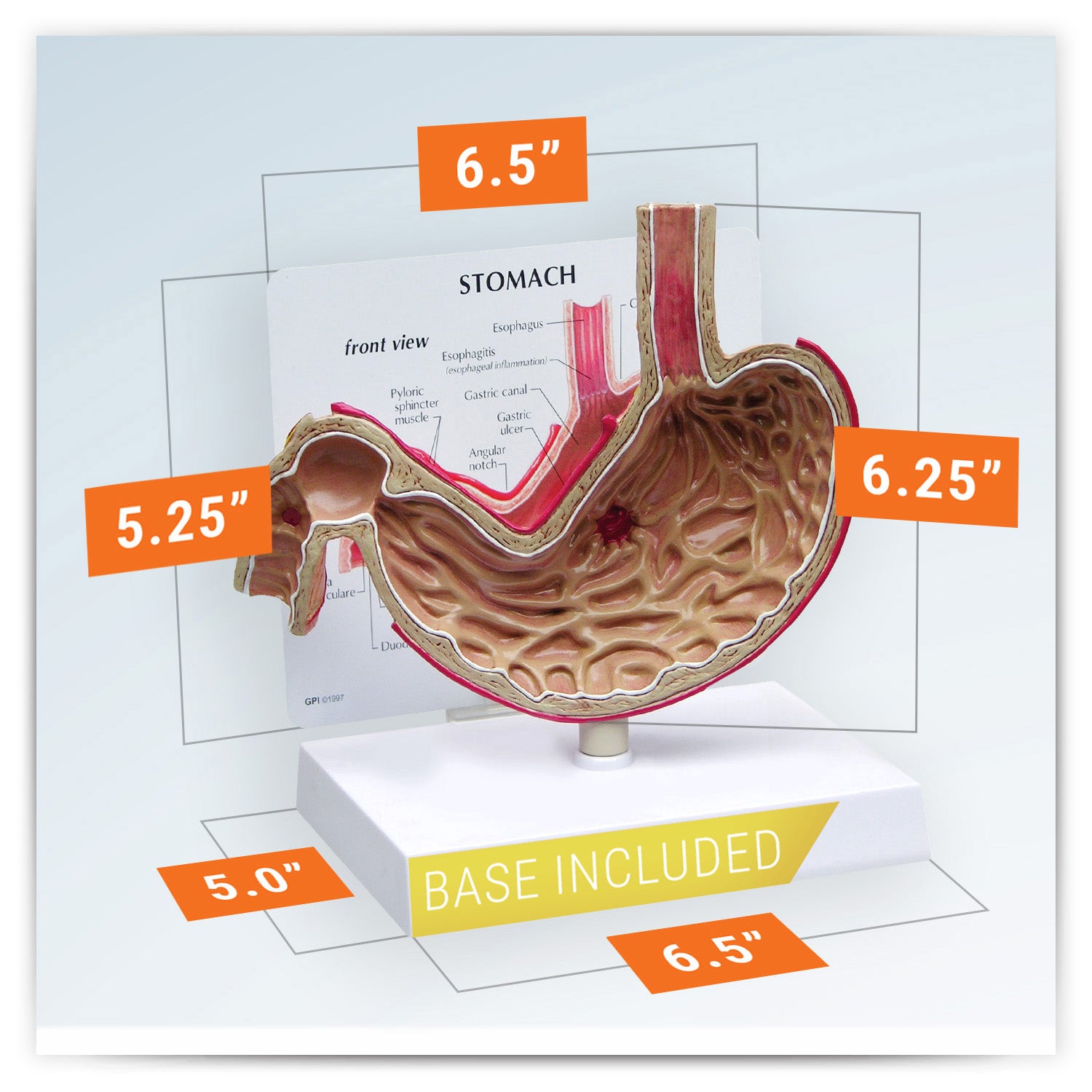 Stomach (with Ulcers)