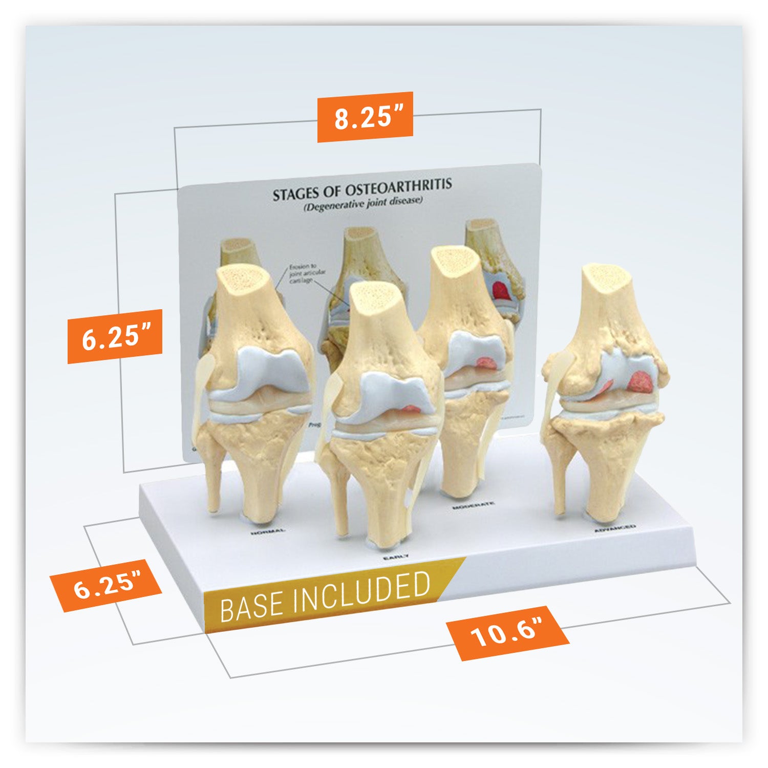 4-Stage Osteoarthritis Knee Set