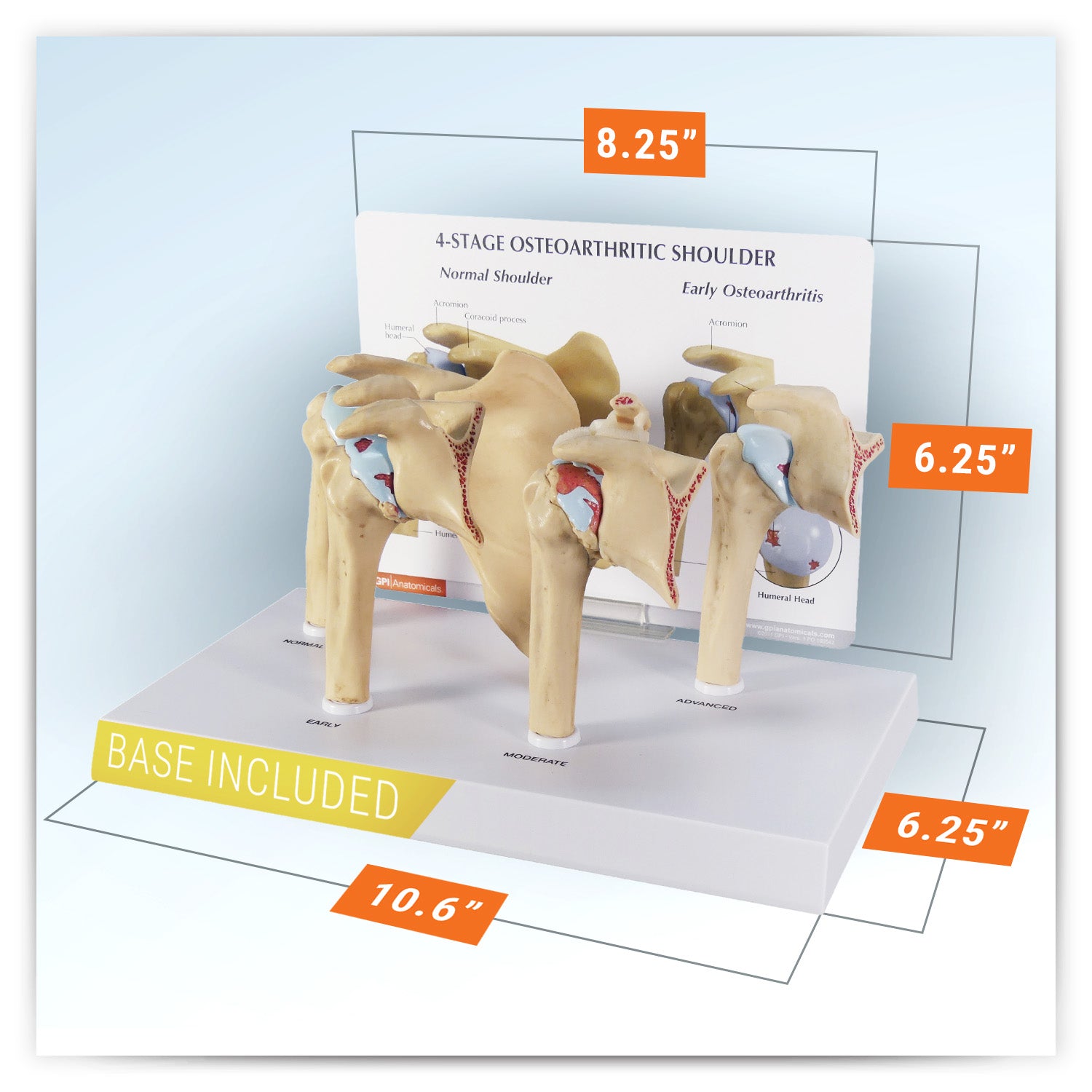 4-Stage Shoulder (Osteoarthritis)