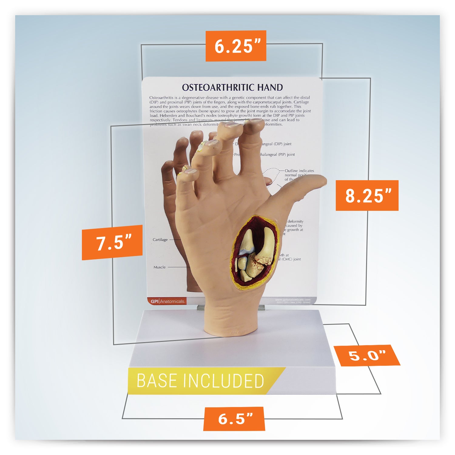 Osteoarthritis (OA) Hand